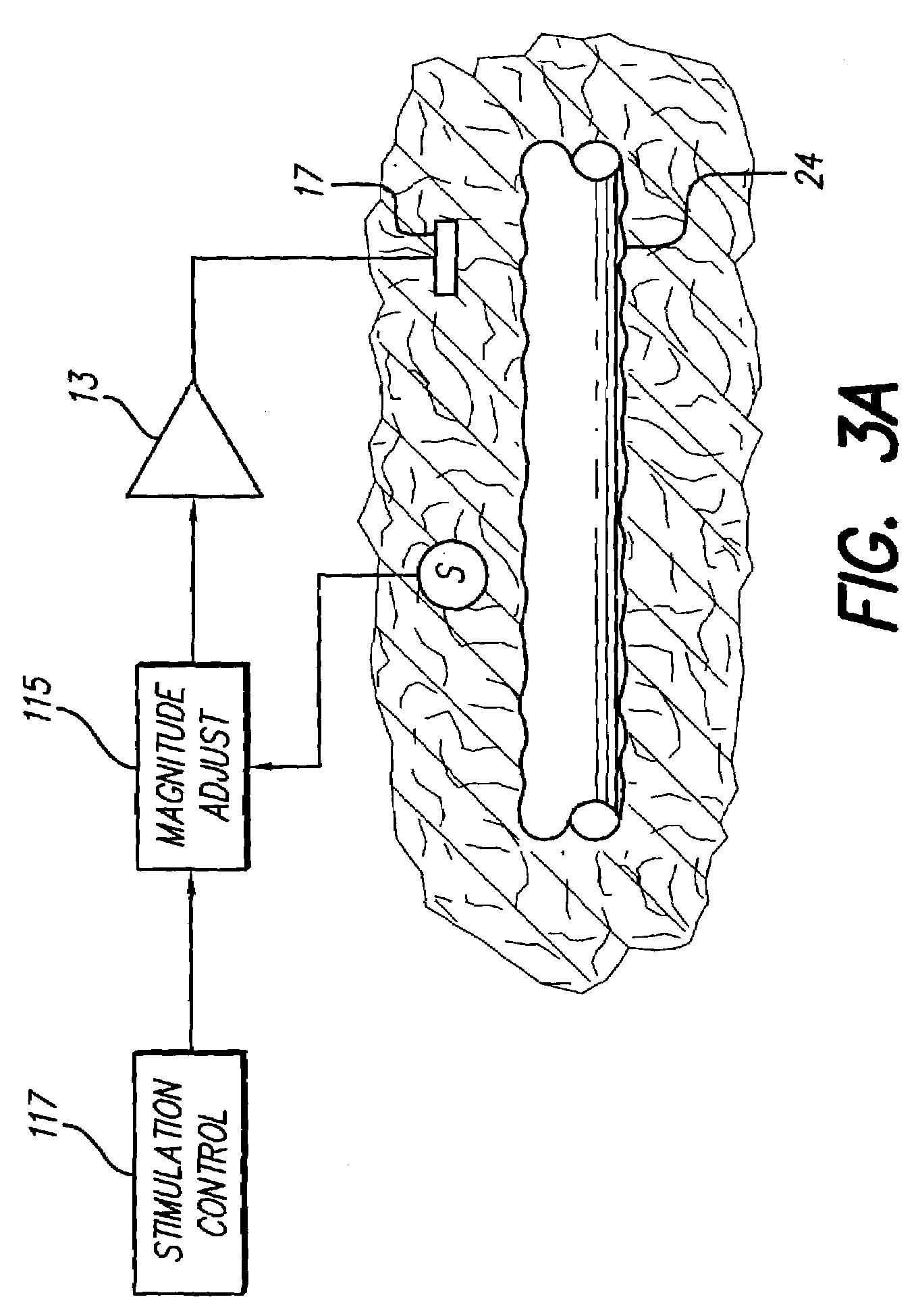 Neural stimulation system providing auto adjustment of stimulus output as a function of sensed impedance