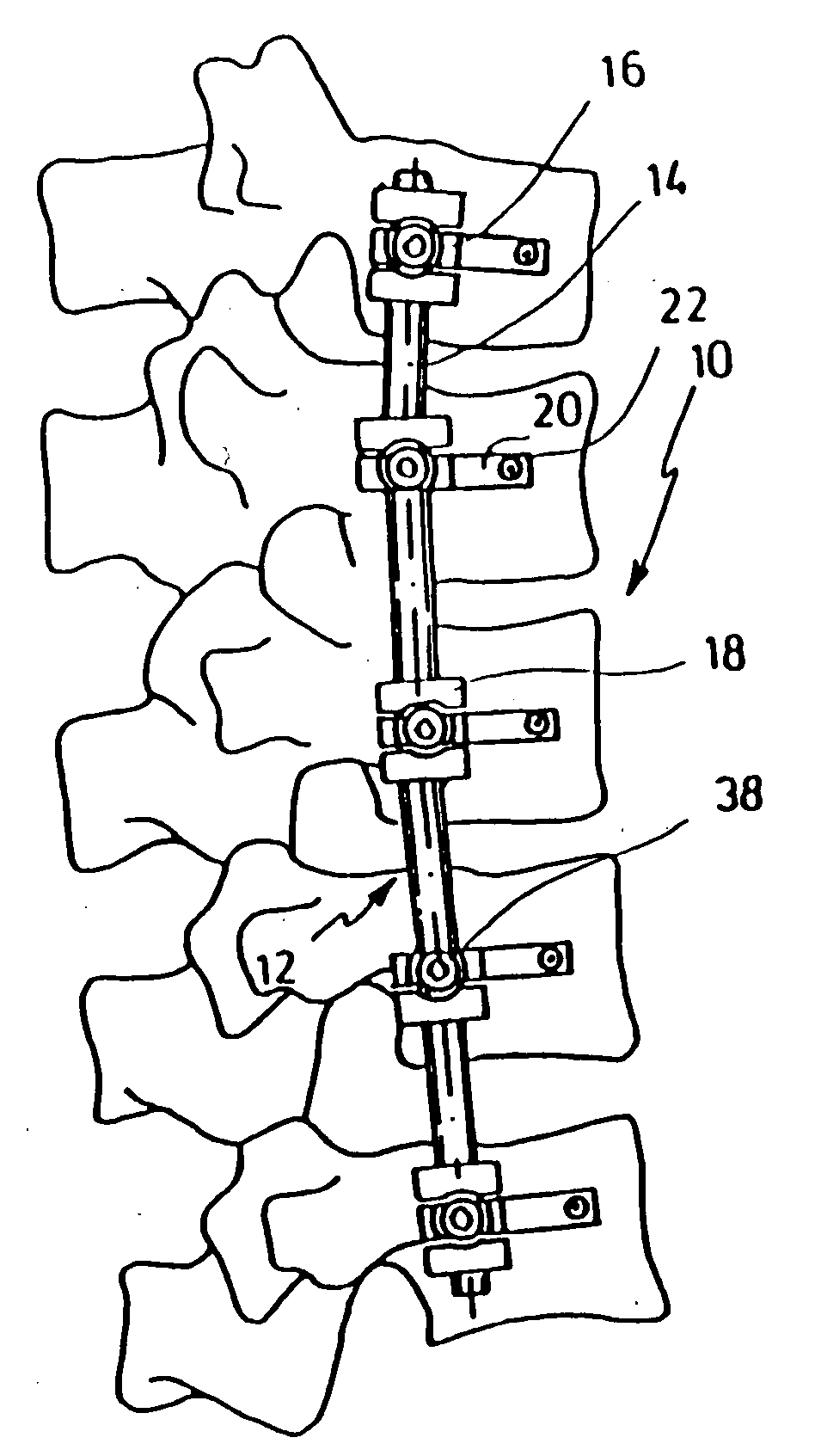 Apparatus for bracing vertebrae