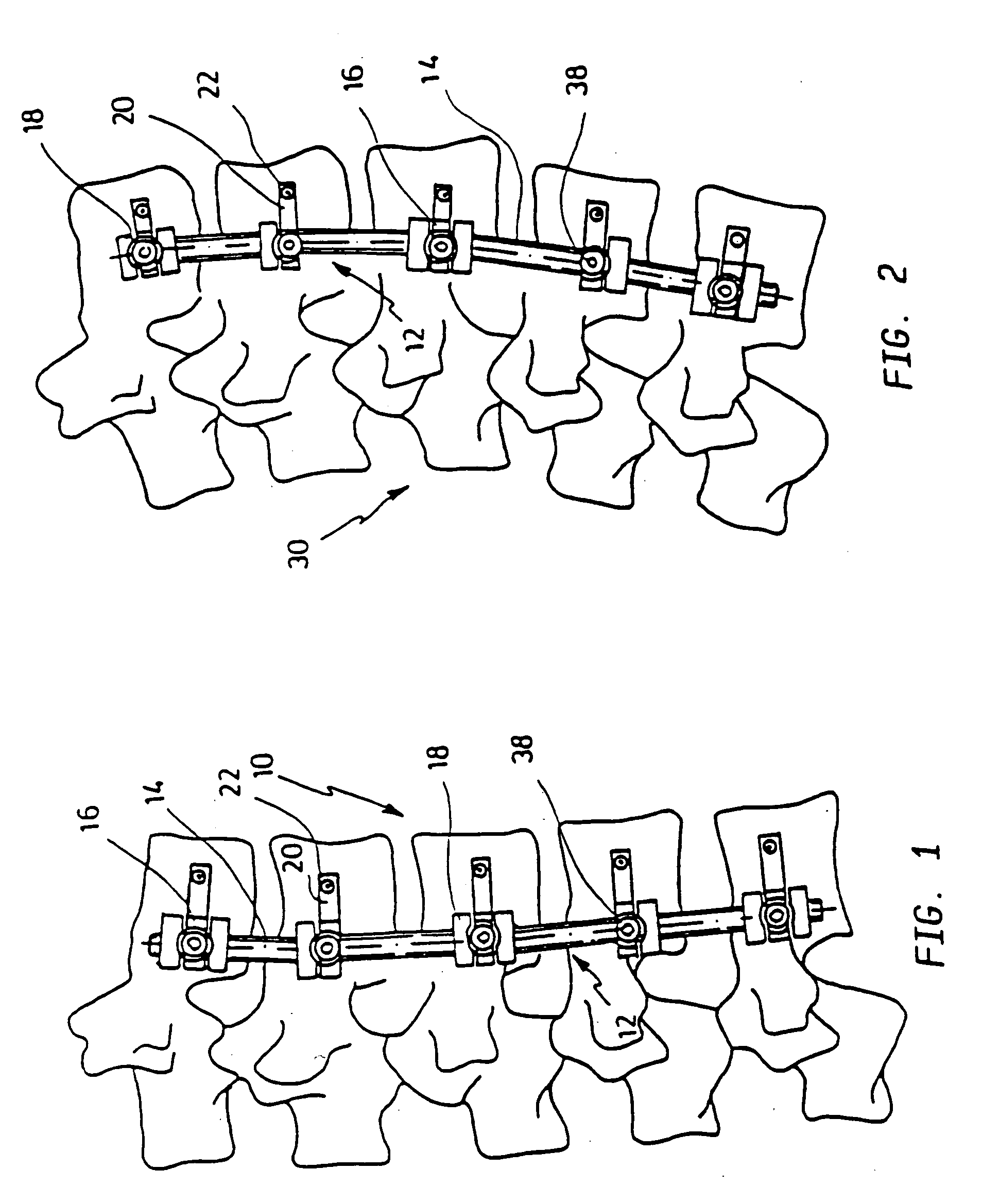 Apparatus for bracing vertebrae