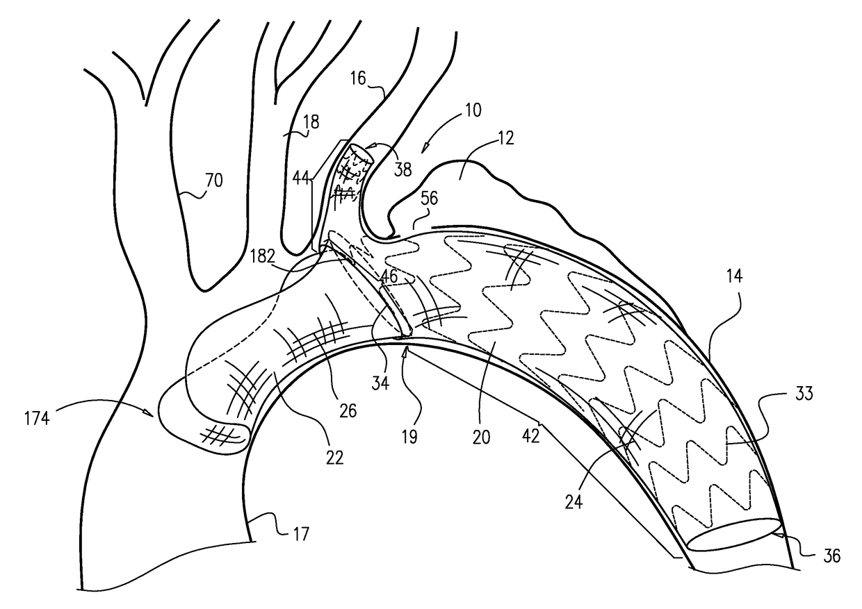 Multi-component stent-graft system for aortic dissections