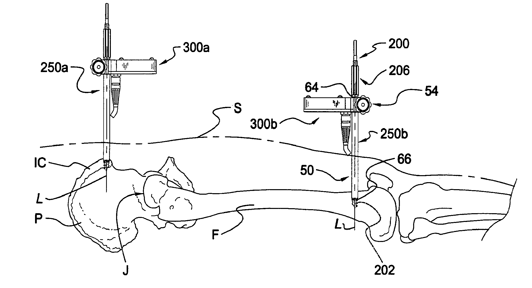 Instrumentation and method for mounting a surgical navigation reference device to a patient