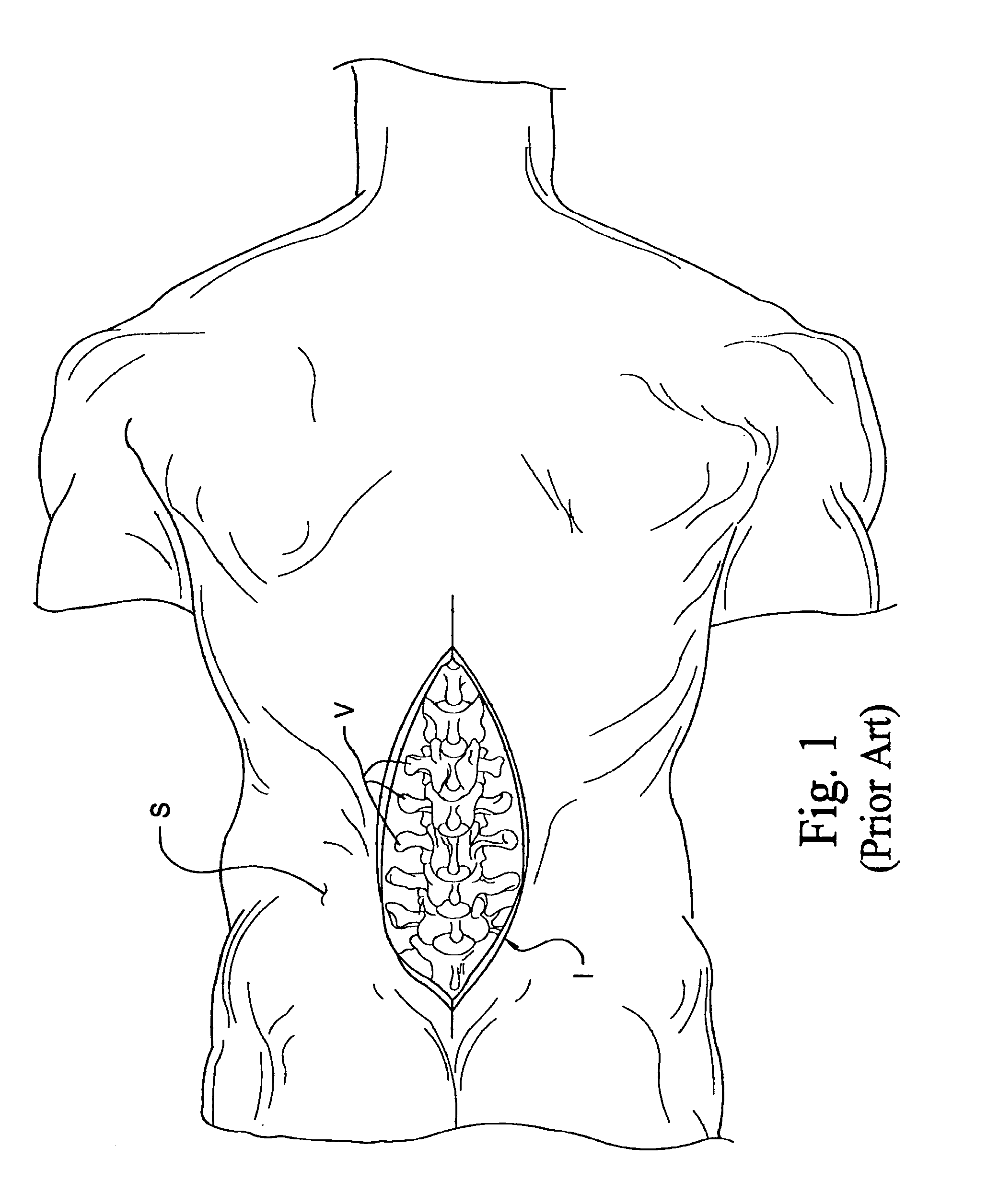 Instrumentation and method for mounting a surgical navigation reference device to a patient