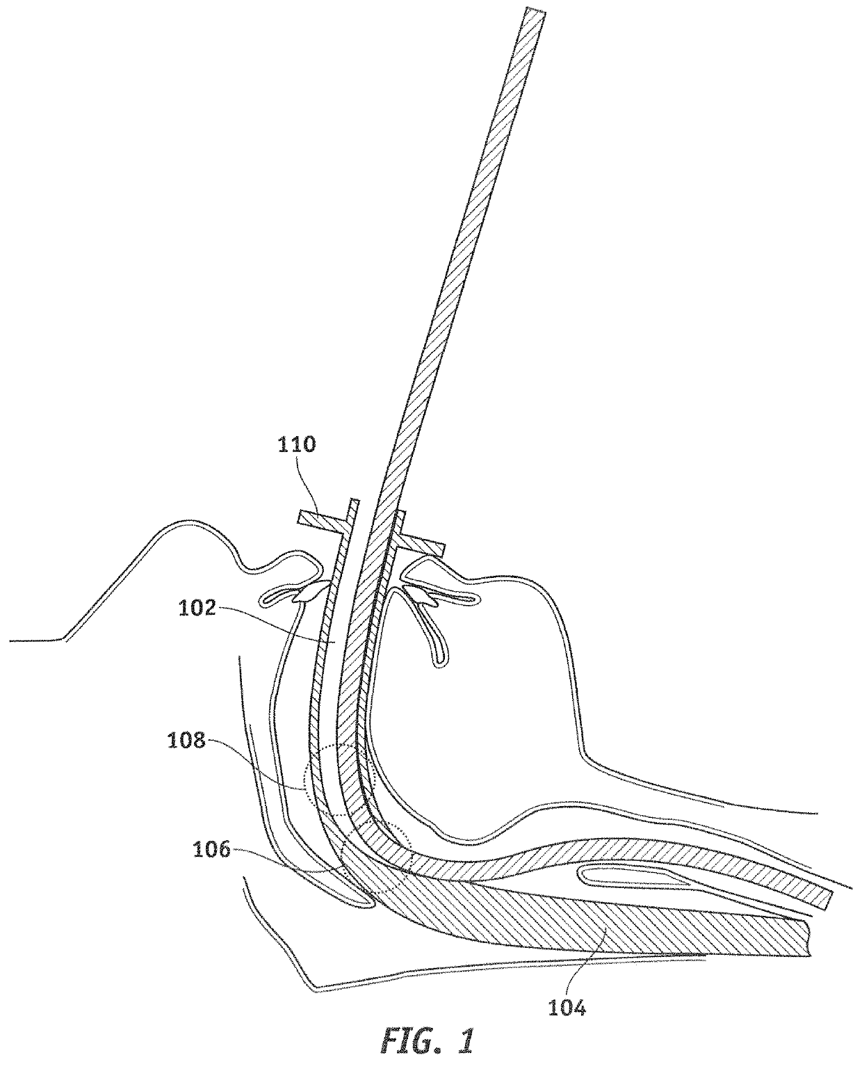 Apparatus for enabling blind endotracheal tube or guide wire insertion into the trachea