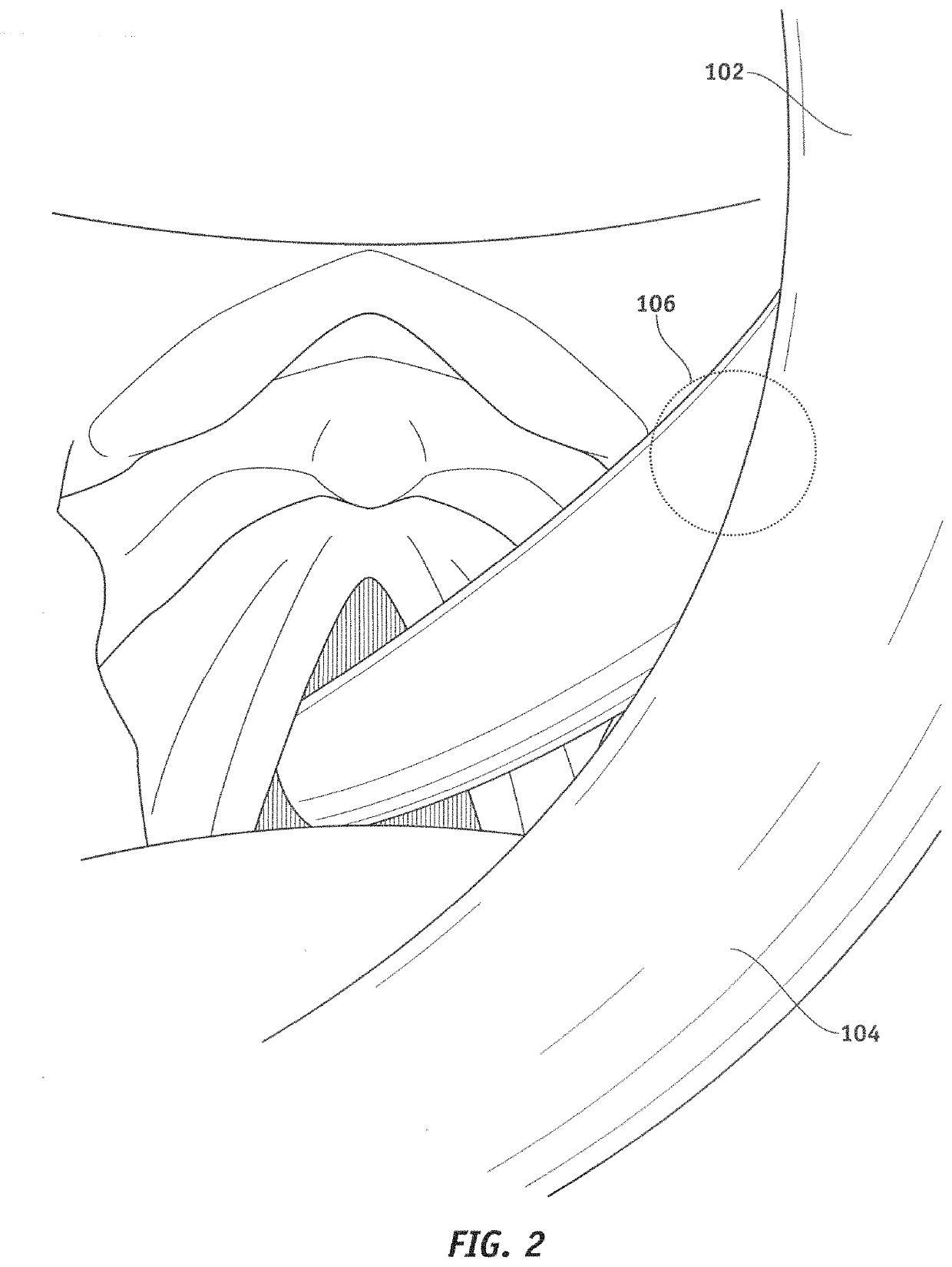 Apparatus for enabling blind endotracheal tube or guide wire insertion into the trachea
