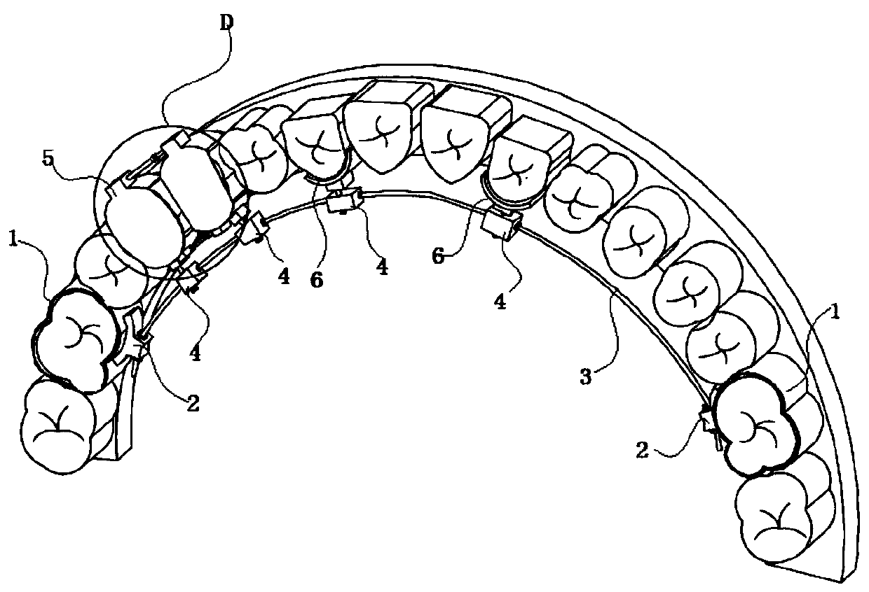 Orthodontics device