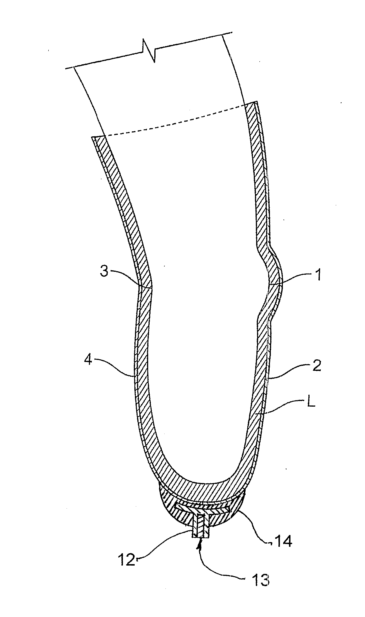 Prosthetic Locking Liner With Improved Knee Flexion