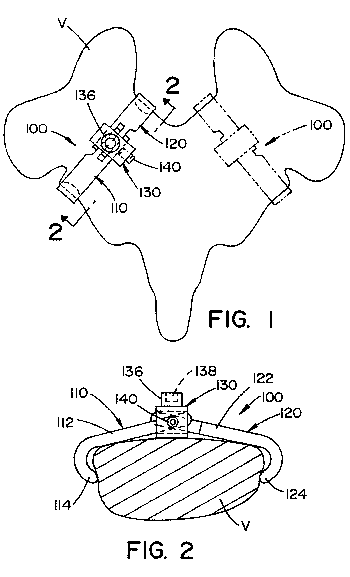 Vertebral pars interarticularis clamp a new spine fixation device, instrumentation, and methodology