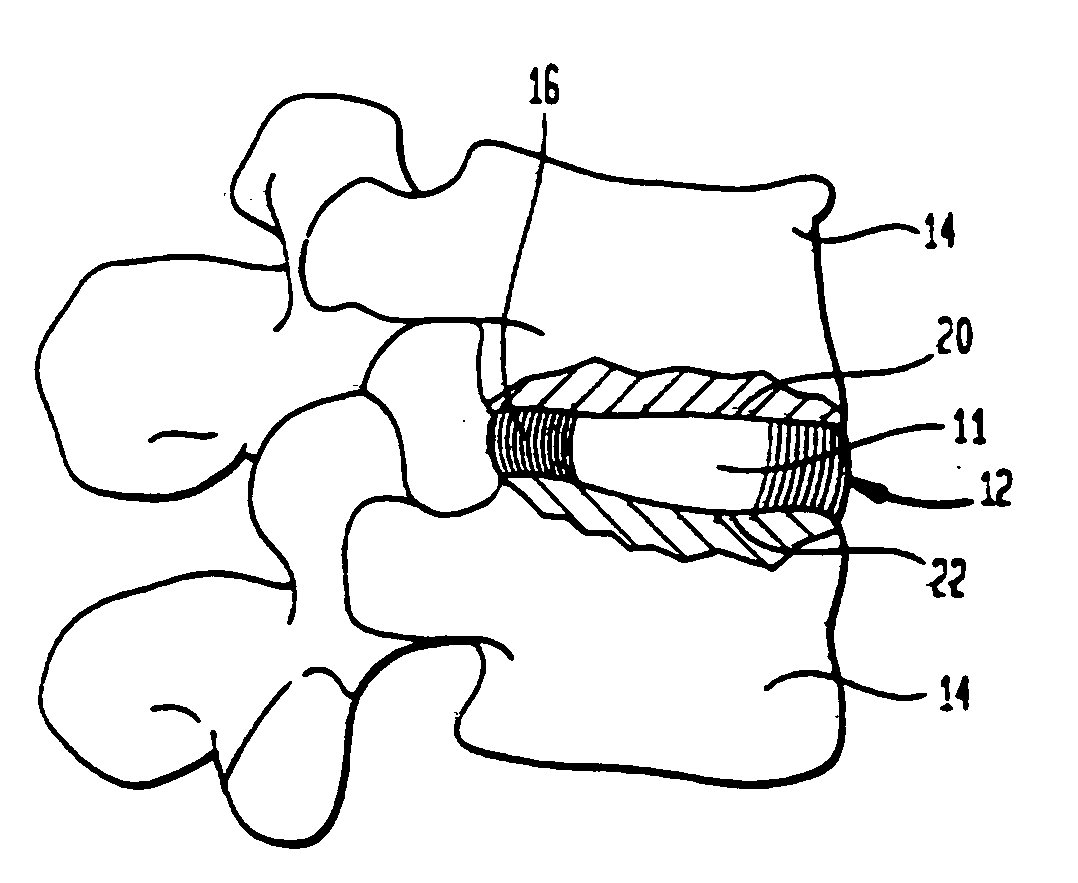 Radiovisible hydrogel intervertebral disc nucleus