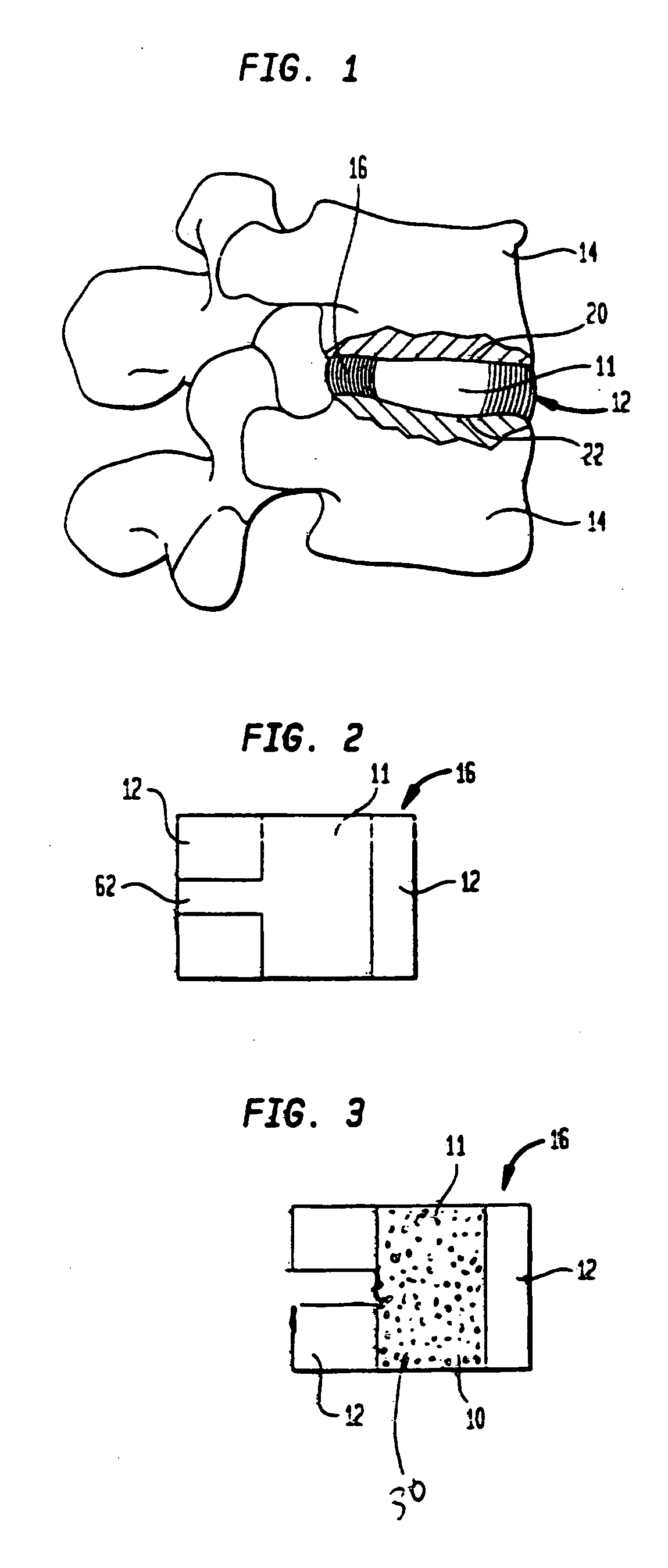 Radiovisible hydrogel intervertebral disc nucleus