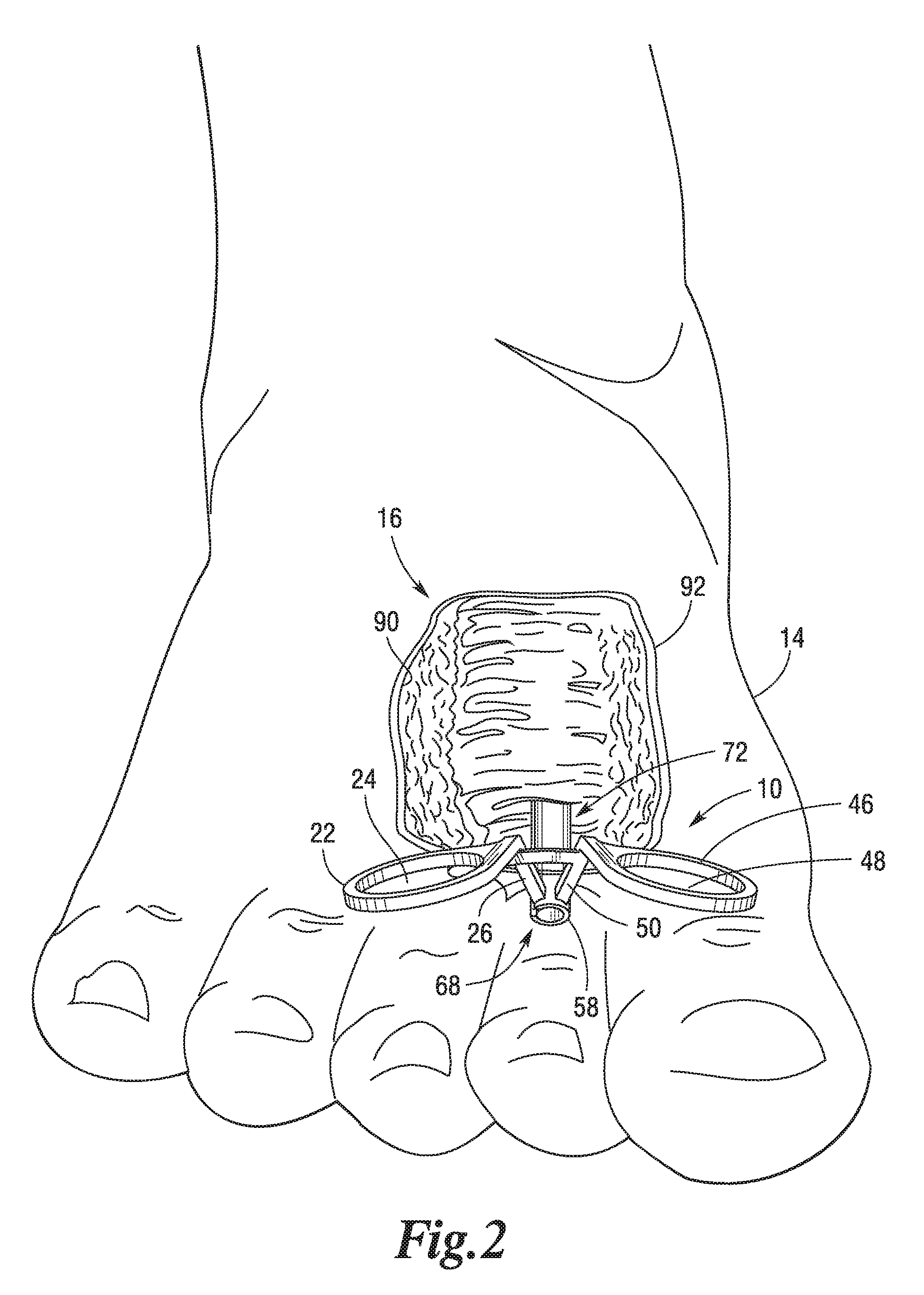 Co-axial actuated scissors