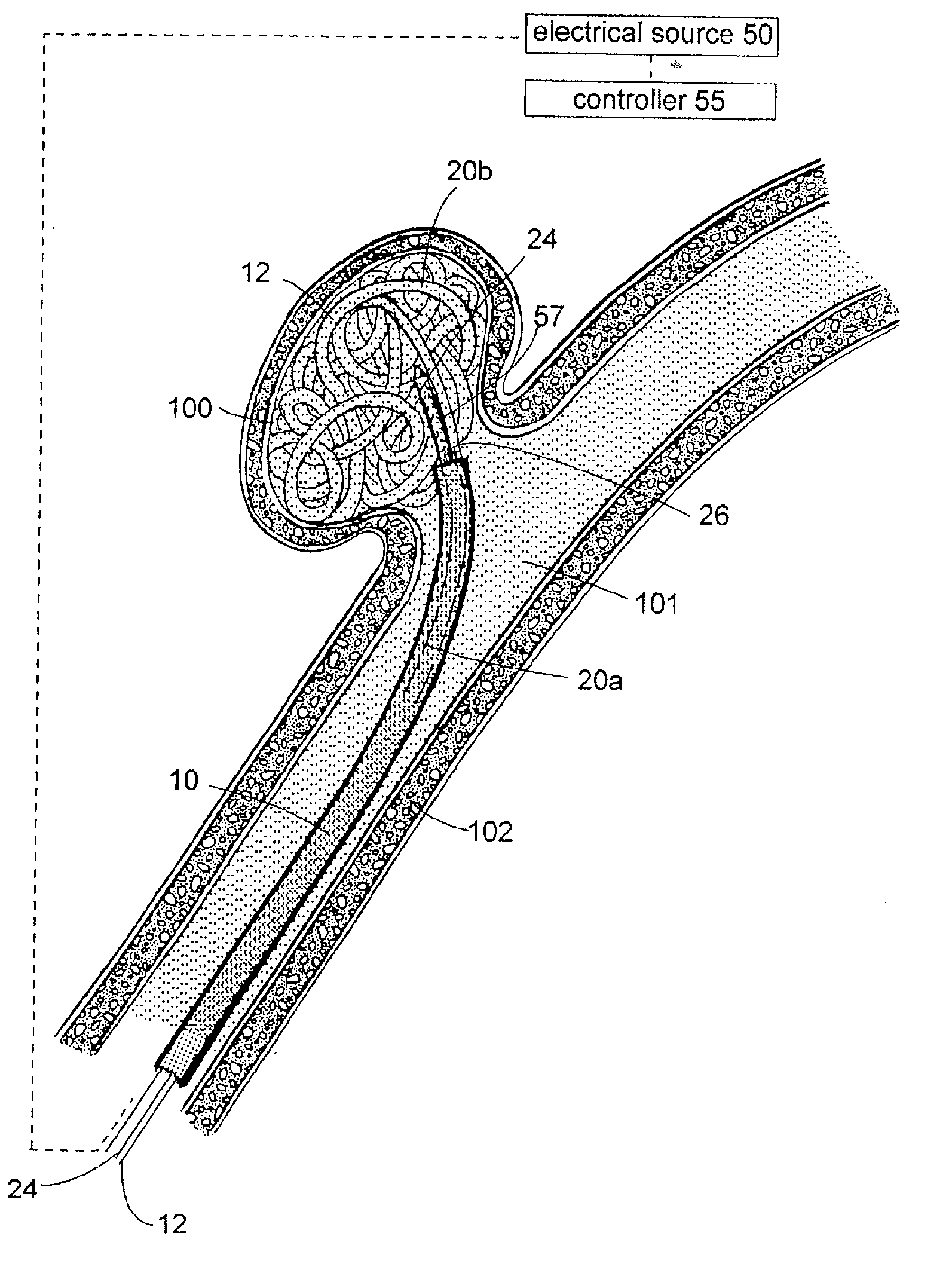 Polymer matrix devices for treatment of vascular malformations