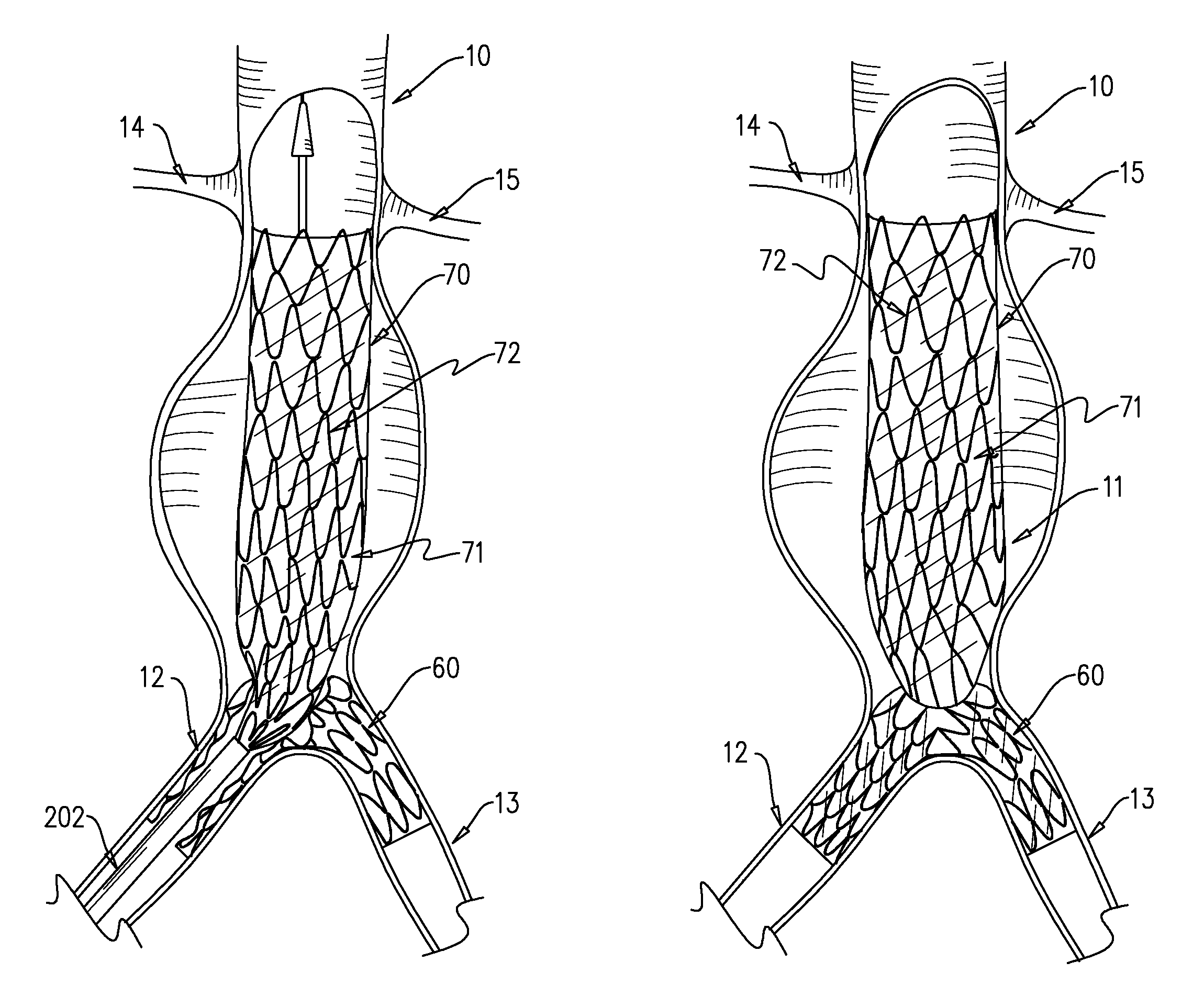 Multi-component expandable supportive bifurcated endoluminal grafts and methods for using same