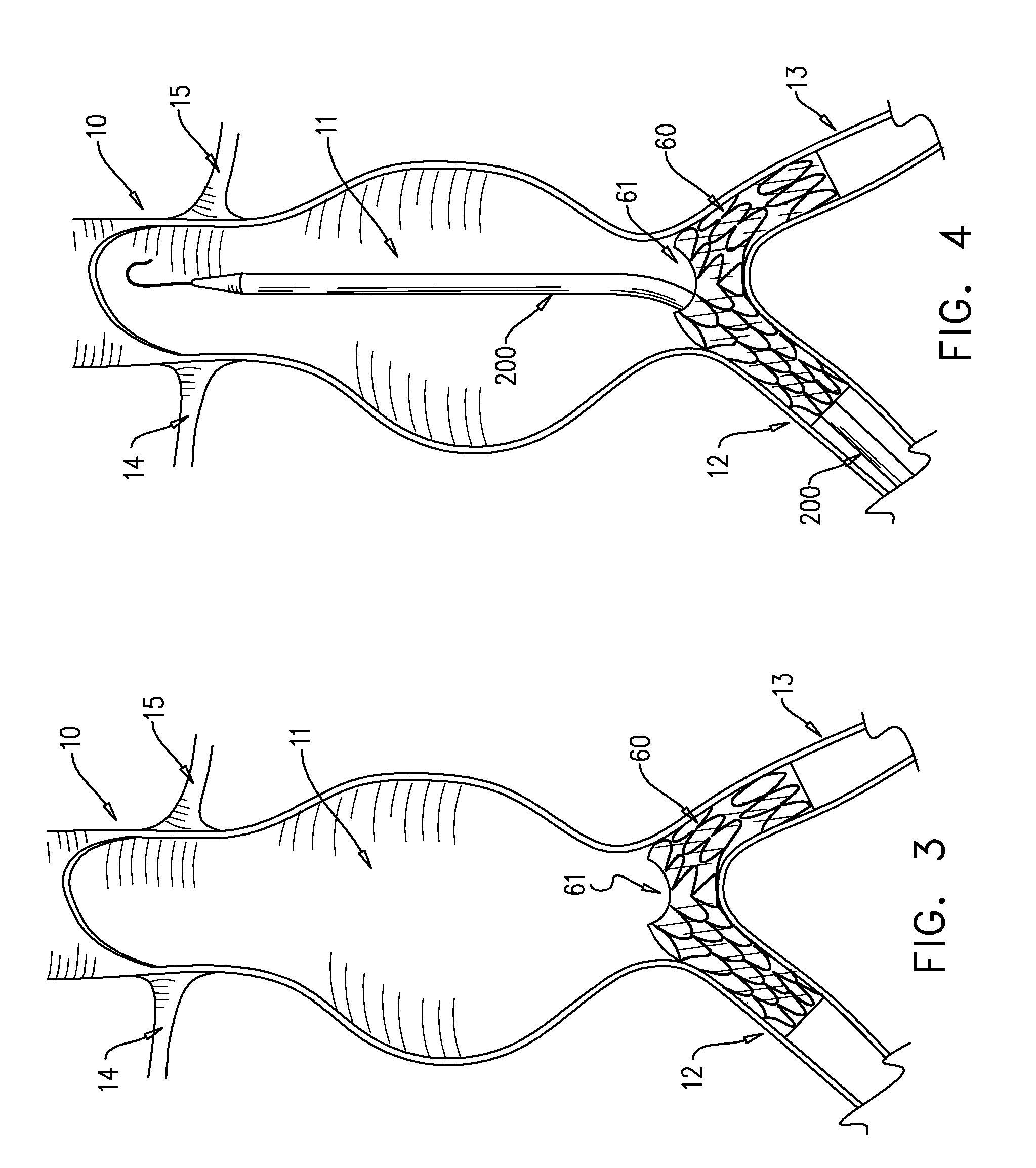 Multi-component expandable supportive bifurcated endoluminal grafts and methods for using same