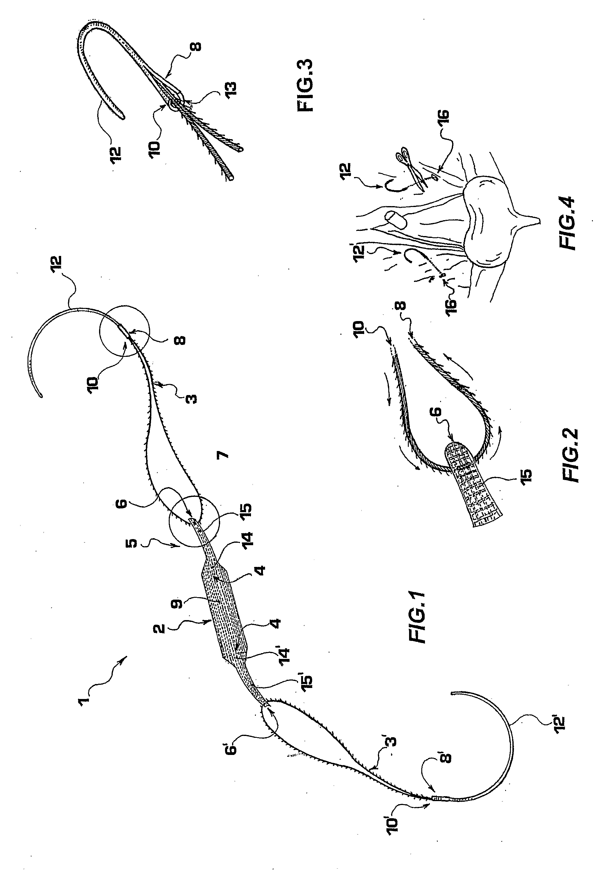 Prosthesis for the treatment of urinary incontinence