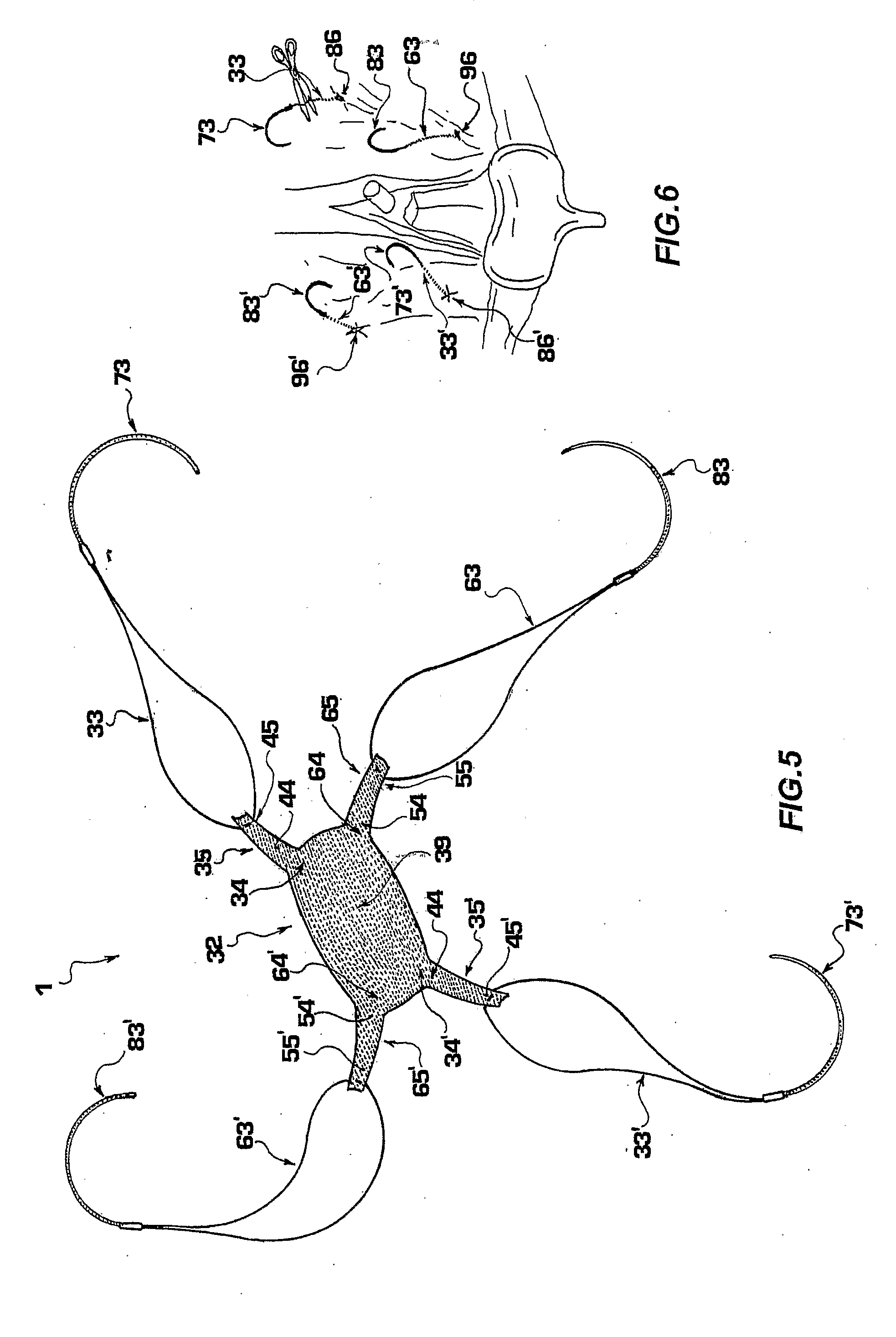 Prosthesis for the treatment of urinary incontinence