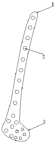 Distal femur dissection locking revision steel plate