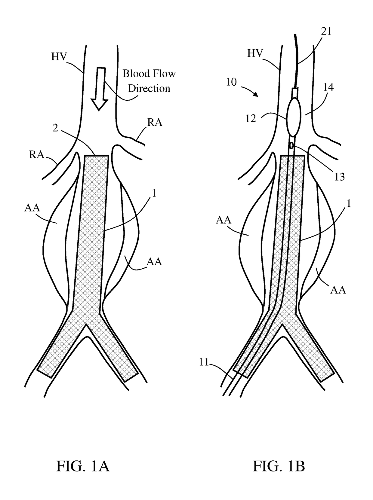 Treating endoleakages in aortic aneurysm repairs