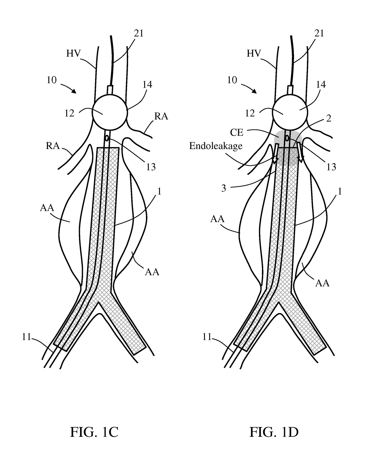 Treating endoleakages in aortic aneurysm repairs