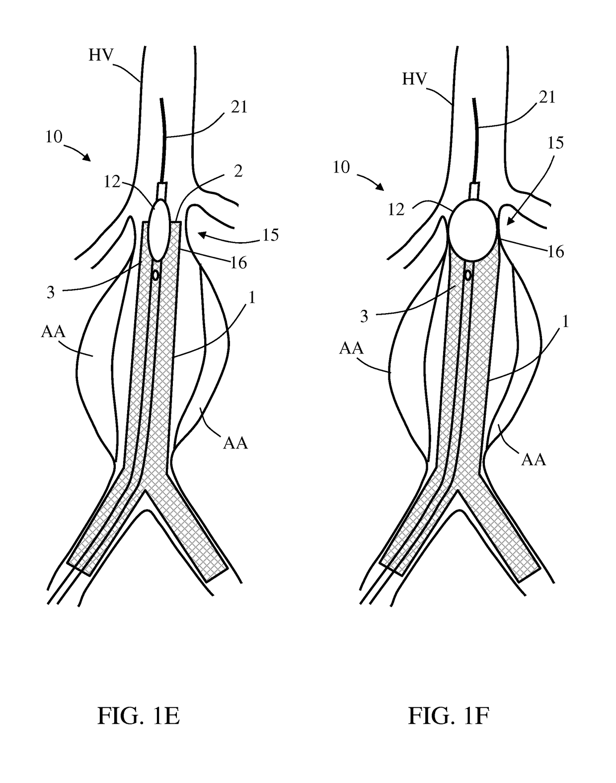 Treating endoleakages in aortic aneurysm repairs