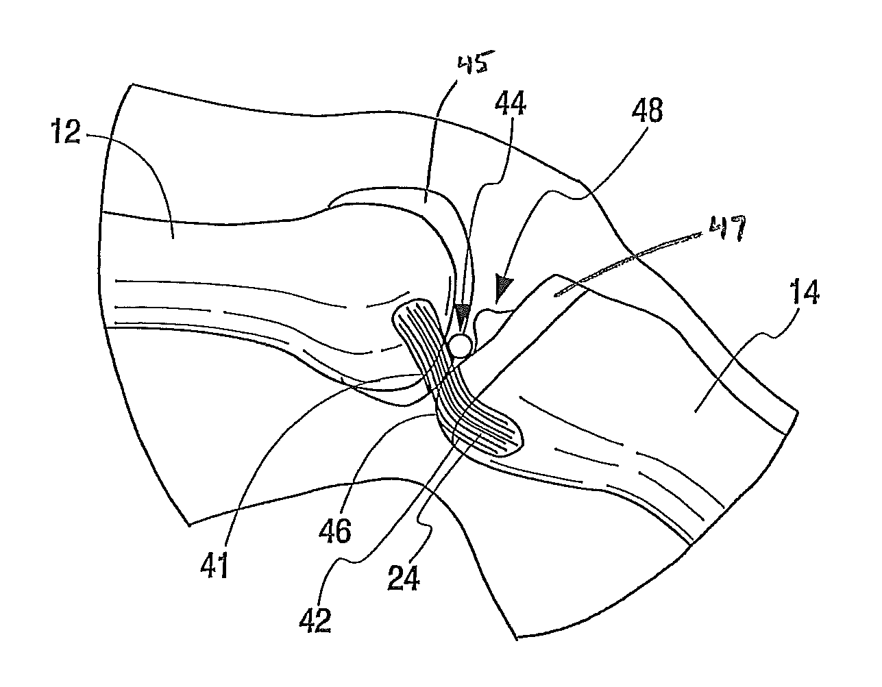 PCL retaining ACL substituting TKA apparatus and method