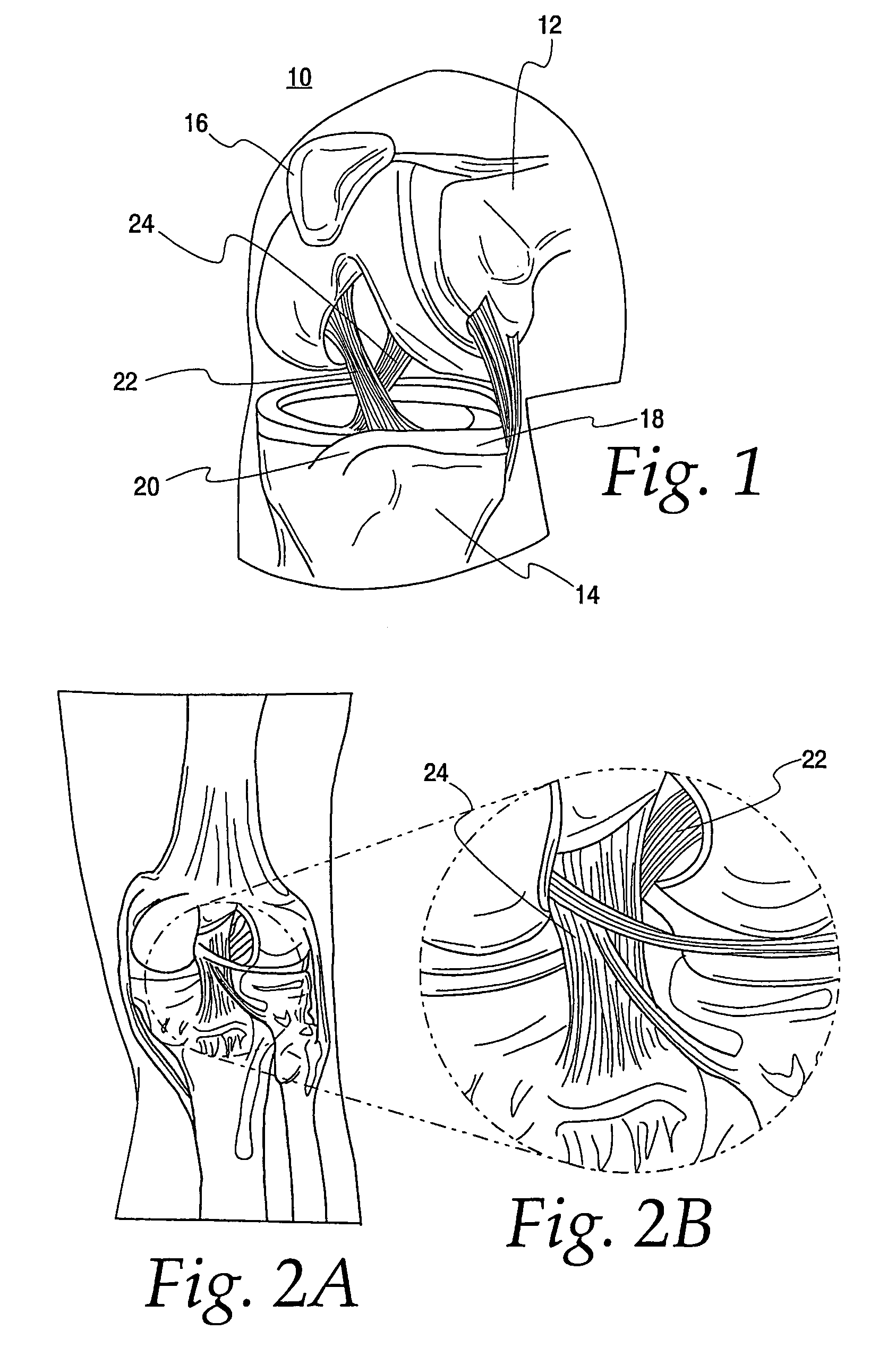 PCL retaining ACL substituting TKA apparatus and method