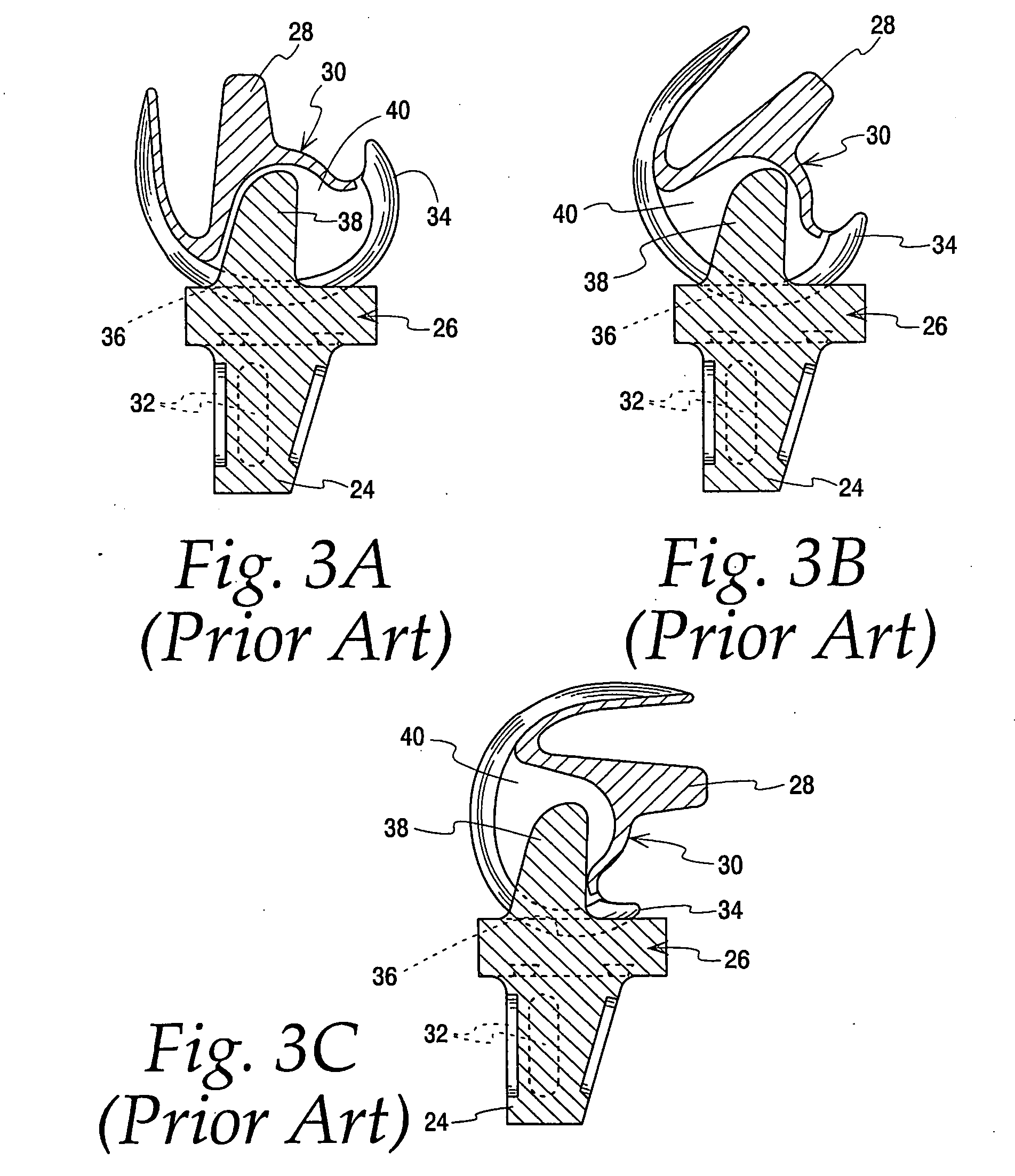 PCL retaining ACL substituting TKA apparatus and method