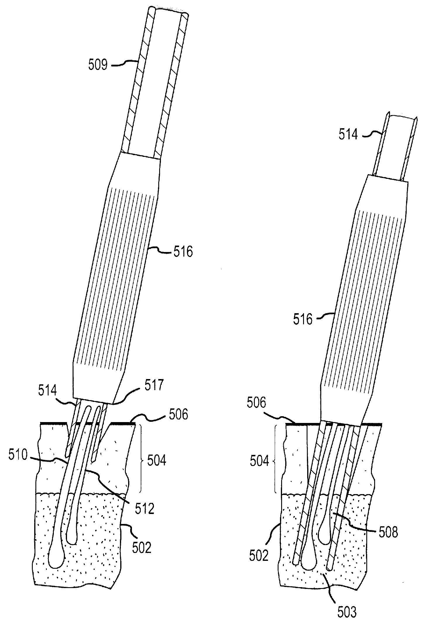 Follicular extraction method and device