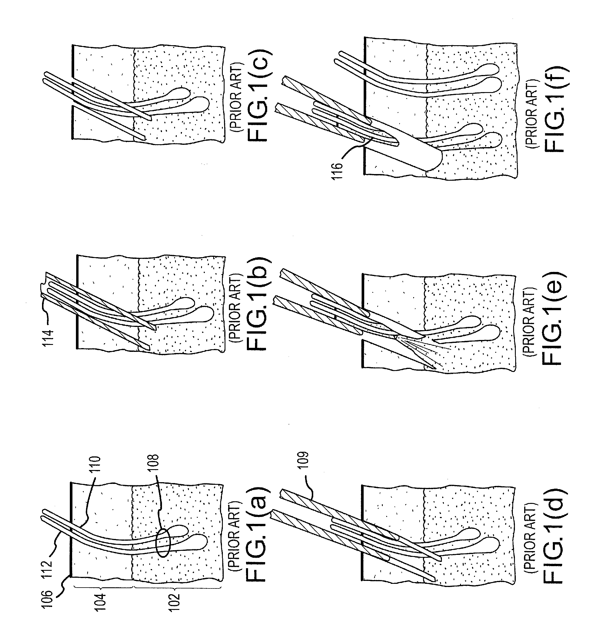 Follicular extraction method and device