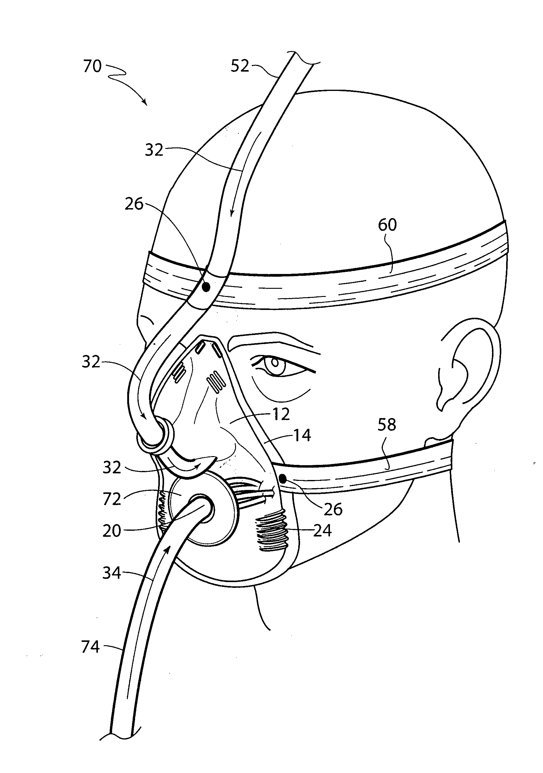 Mask for use with a patient undergoing a sedated endoscopic procedure