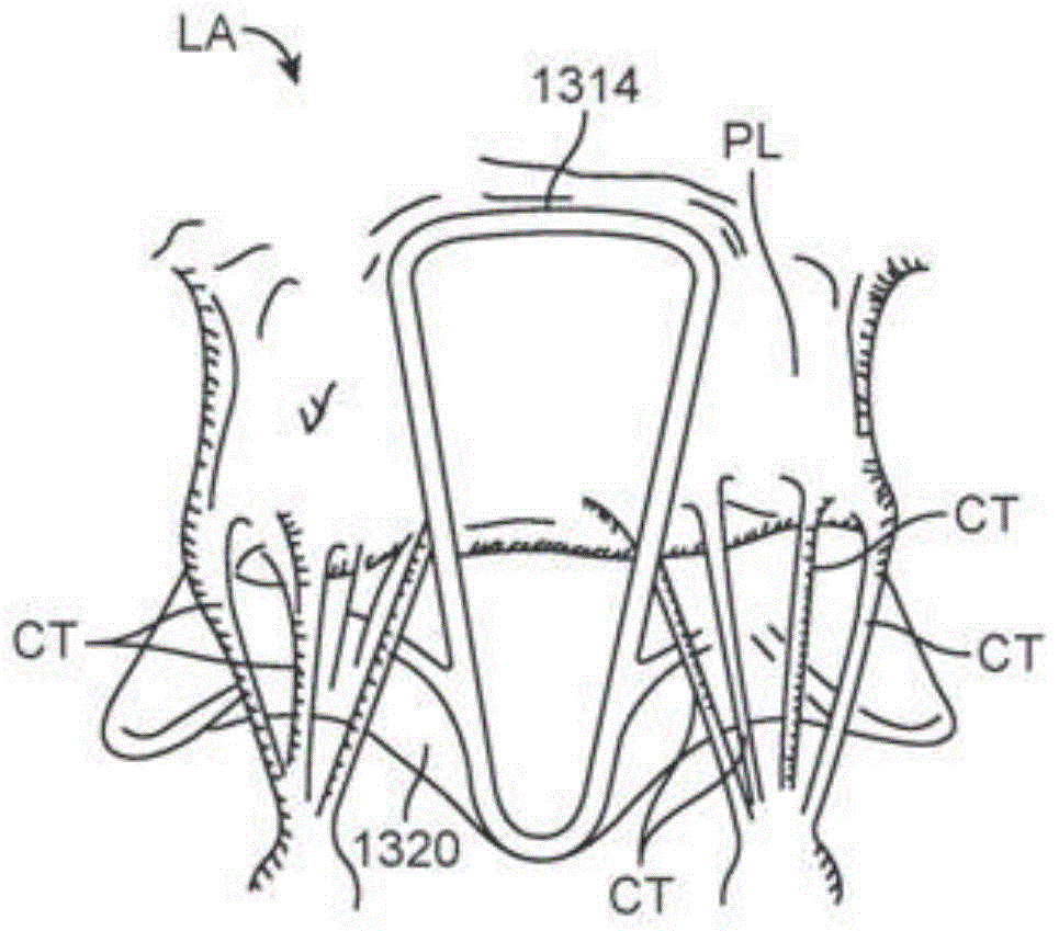 sequentially deployed transcatheter mitral valve prosthesis