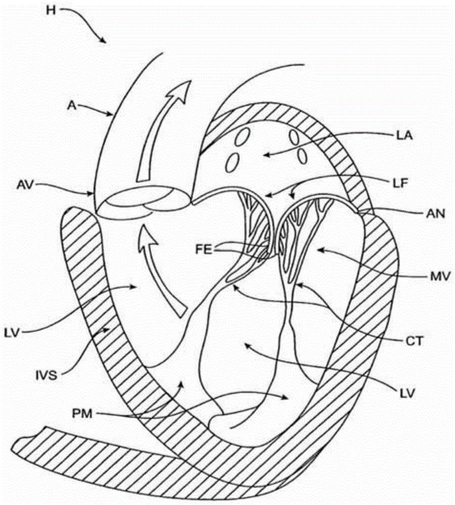 sequentially deployed transcatheter mitral valve prosthesis