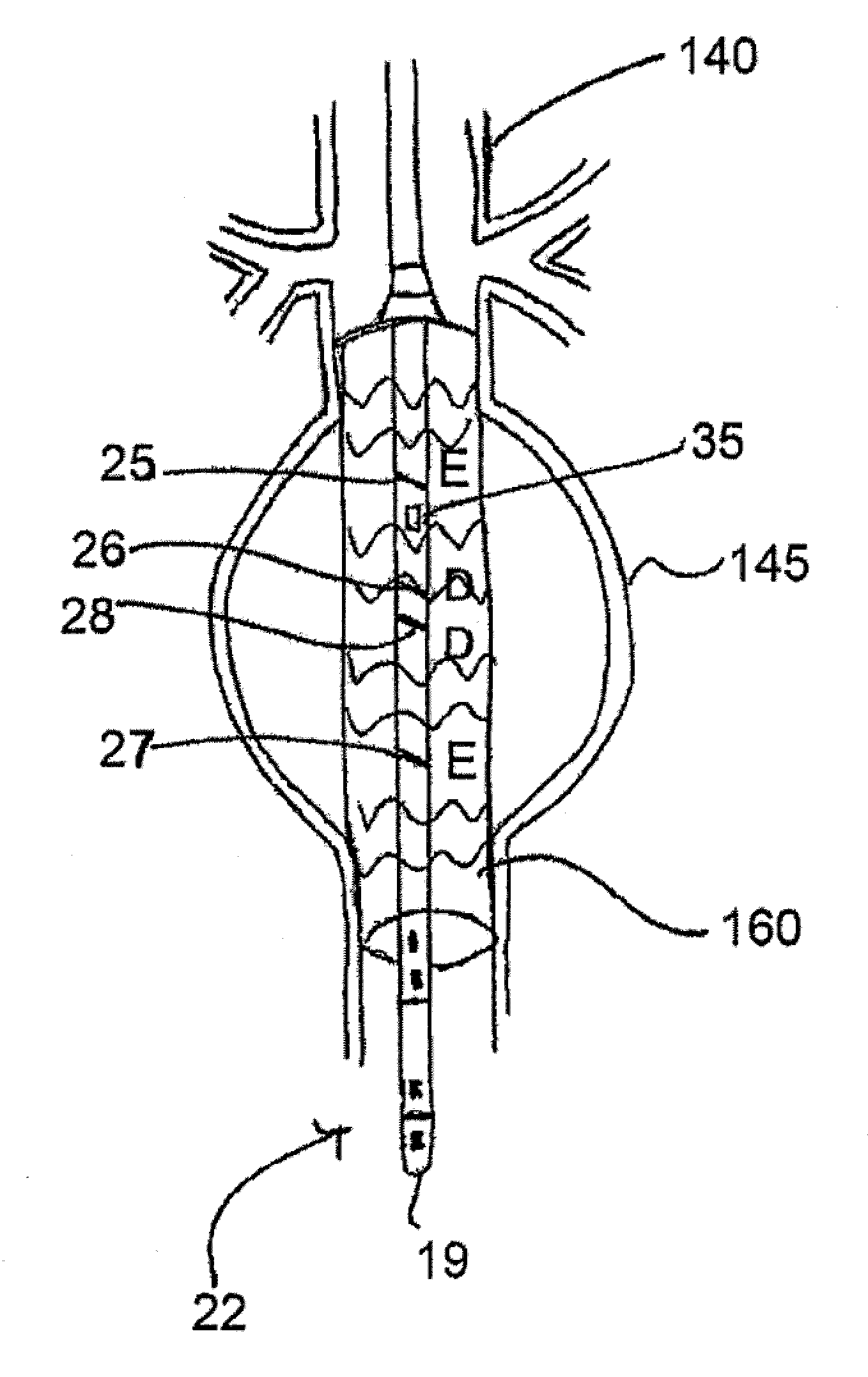 Systems and methods for placing heart leads