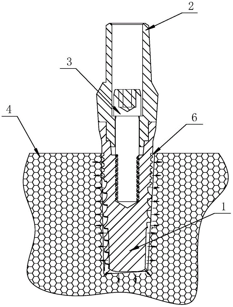 Stable and lasting dental implant structure