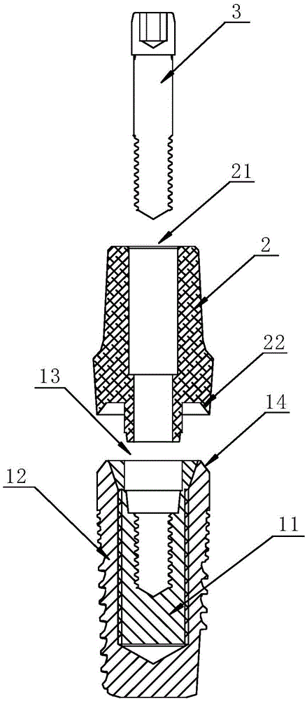 Stable and lasting dental implant structure