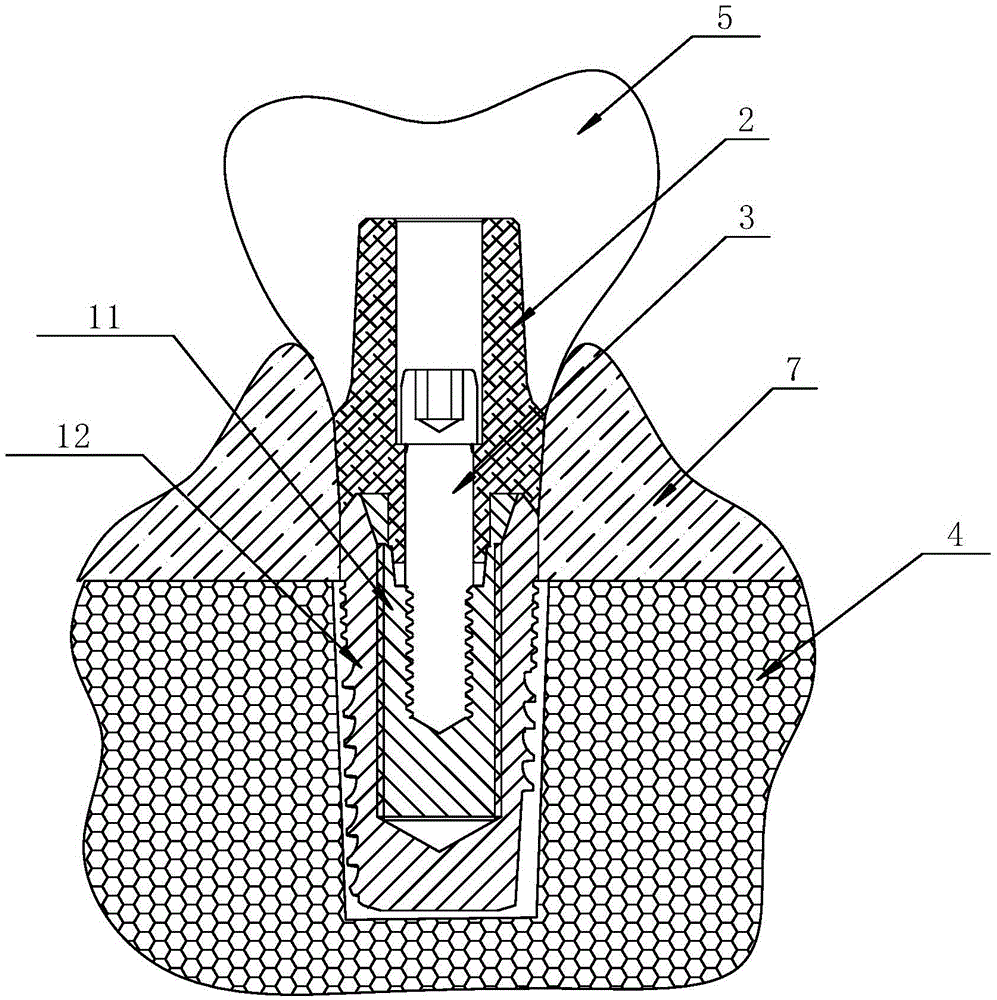 Stable and lasting dental implant structure