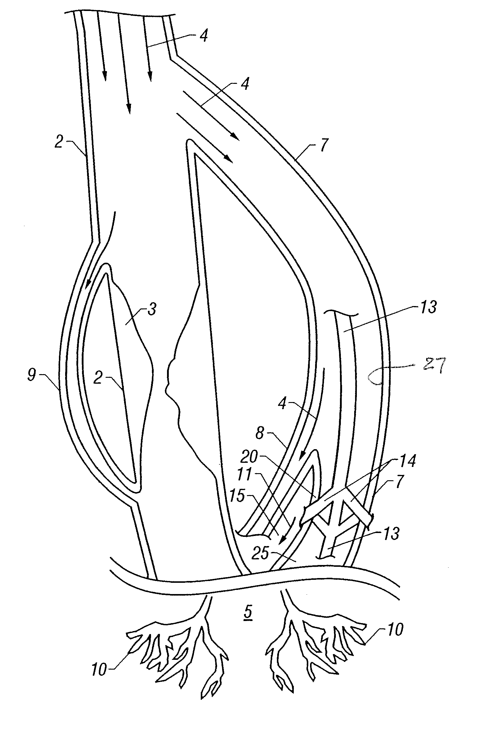 Vessel enlargement by arteriogenic factor delivery