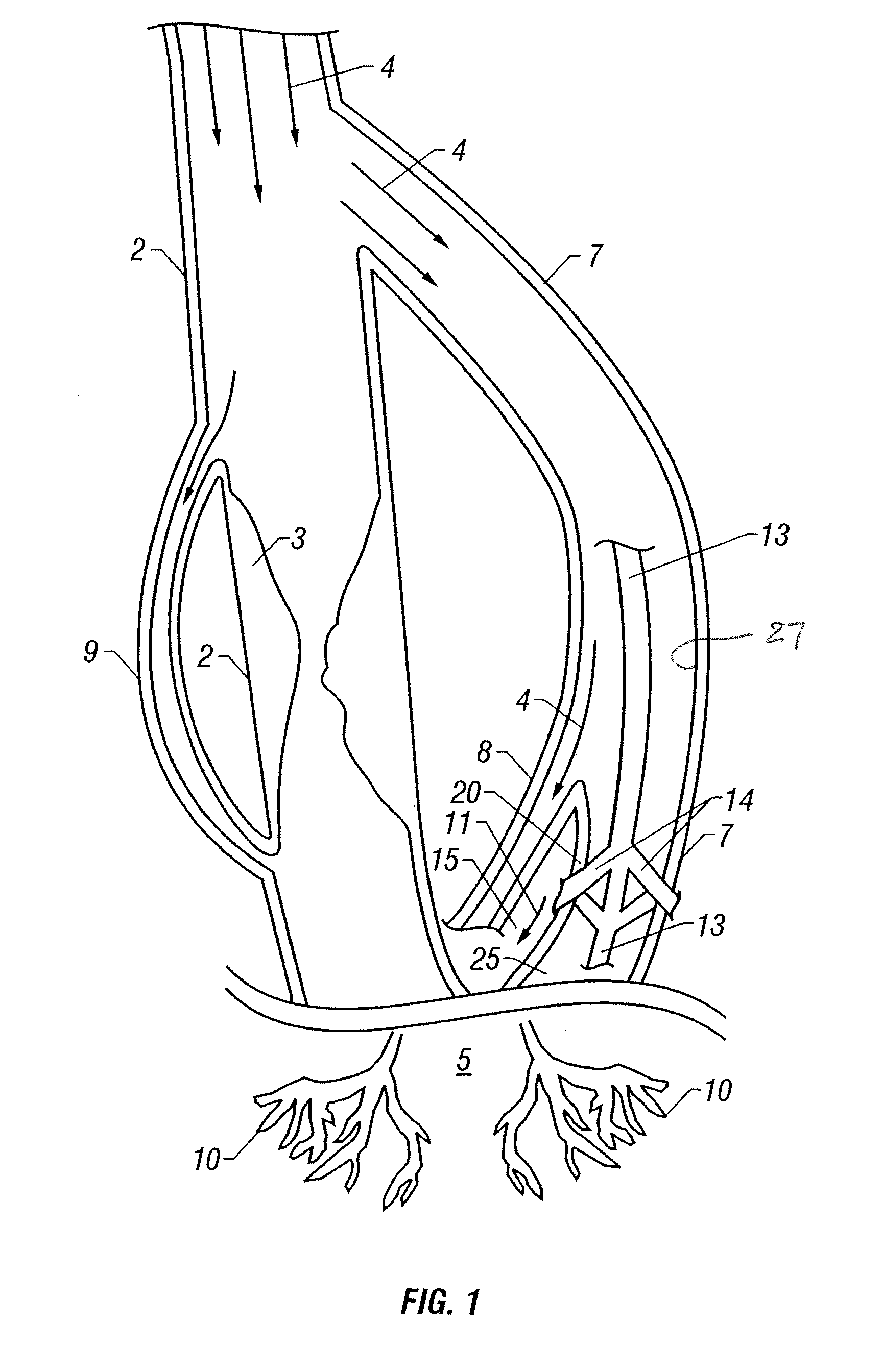 Vessel enlargement by arteriogenic factor delivery