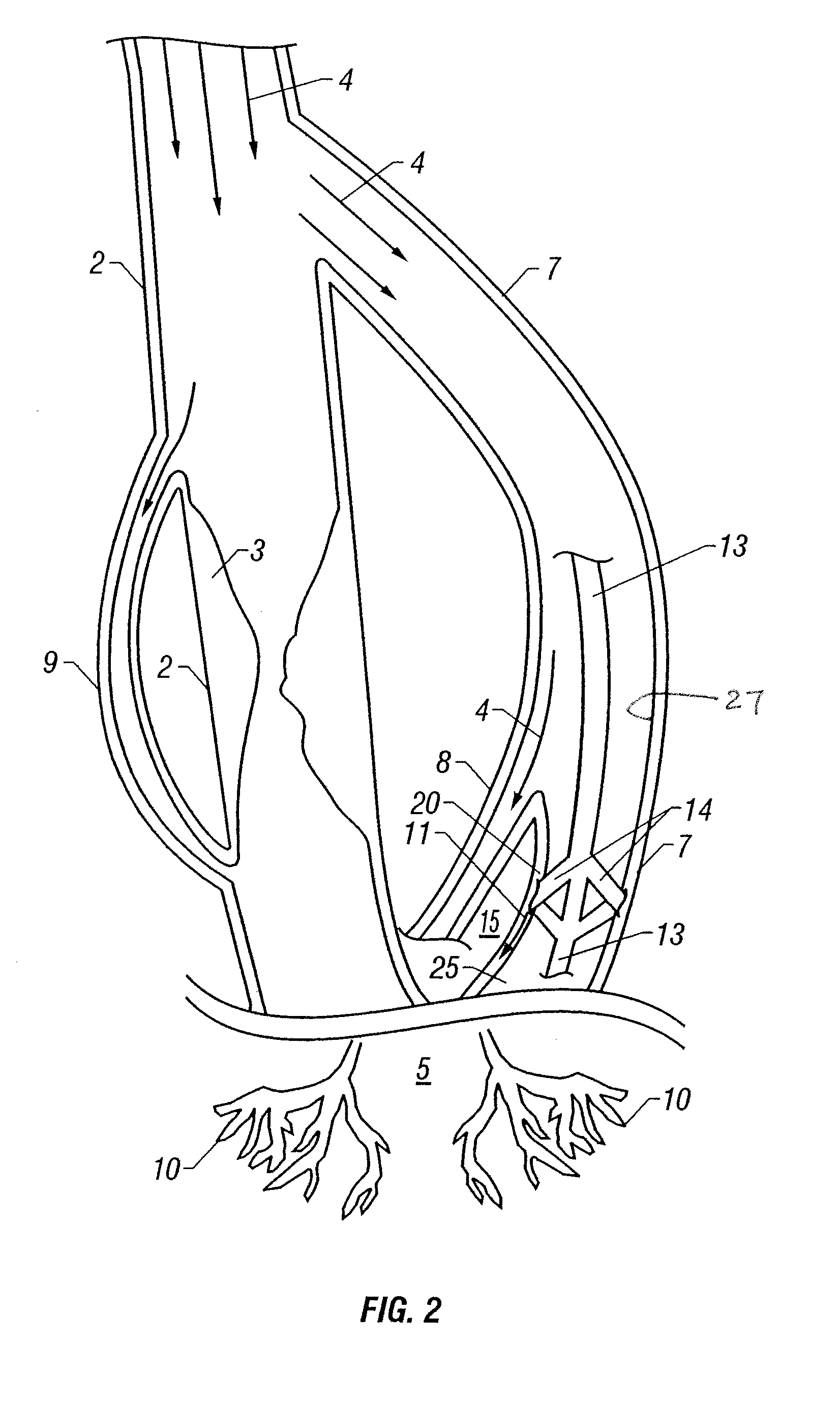 Vessel enlargement by arteriogenic factor delivery