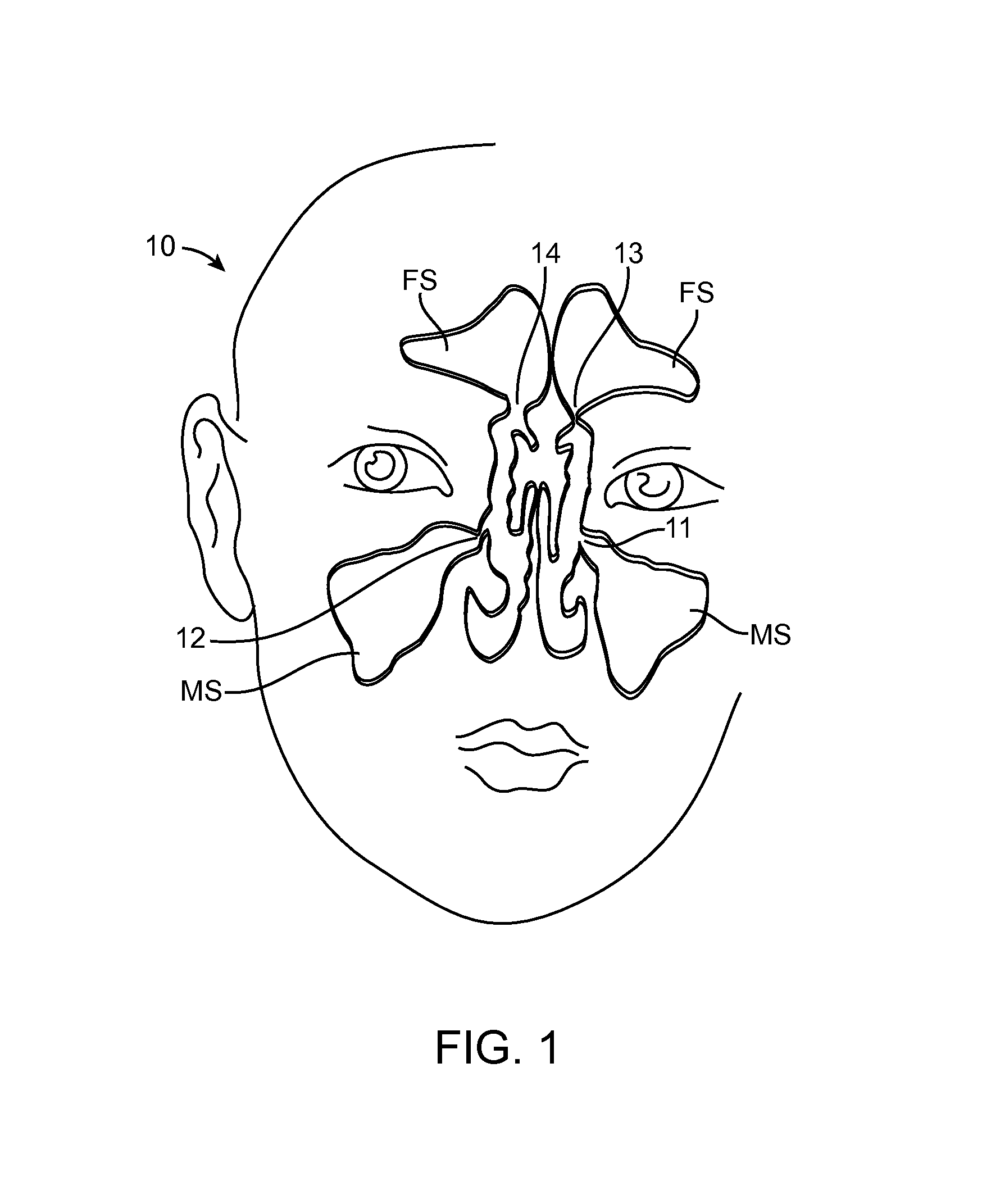 Devices and Methods for Dilating a Paranasal Sinus Opening and for Treating Sinusitis