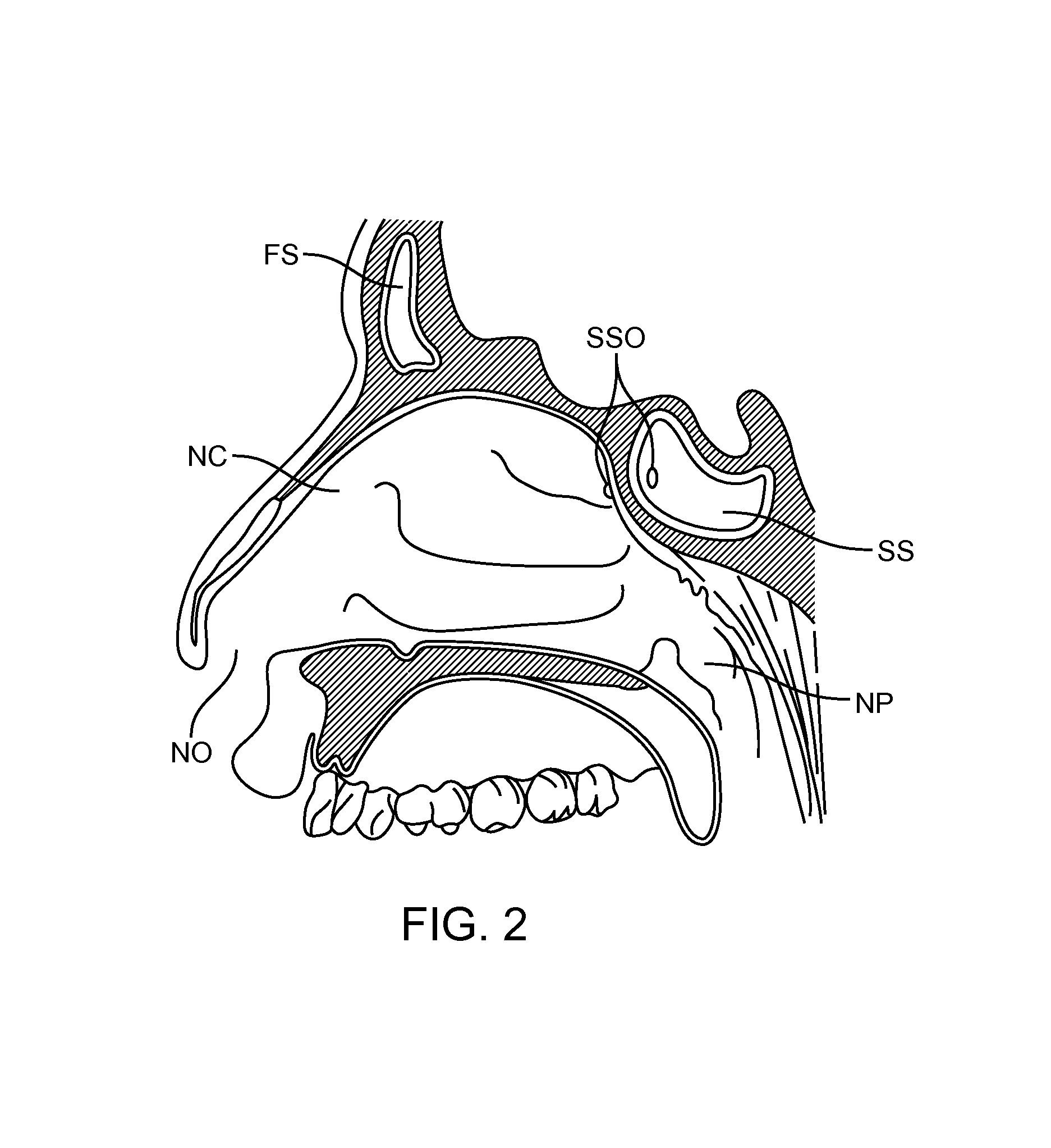 Devices and Methods for Dilating a Paranasal Sinus Opening and for Treating Sinusitis