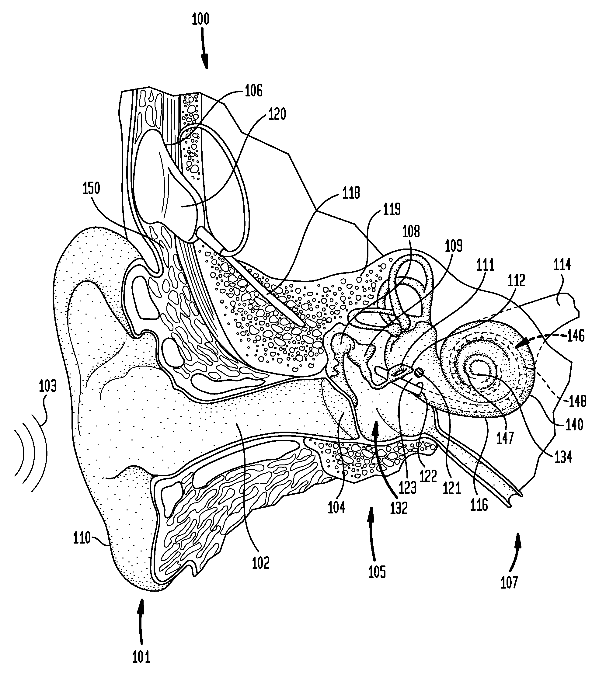 Implantable microphone for an implantable hearing prosthesis