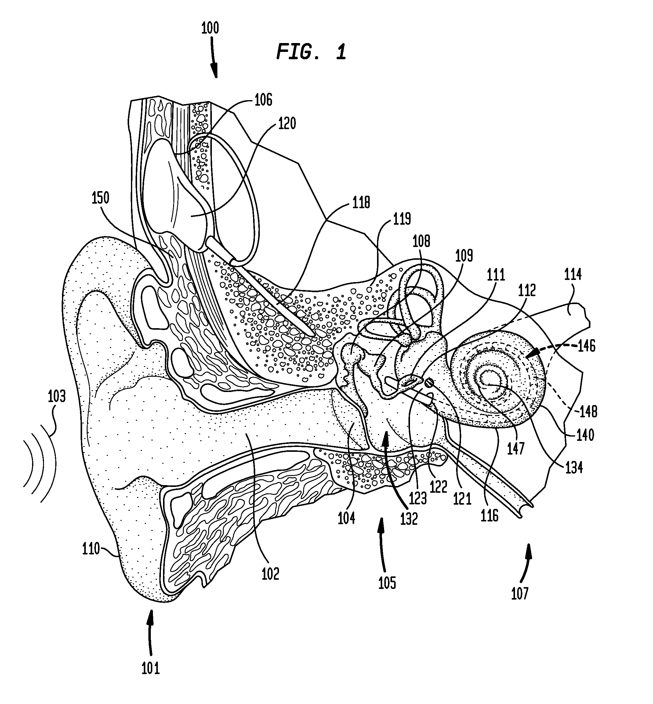 Implantable microphone for an implantable hearing prosthesis