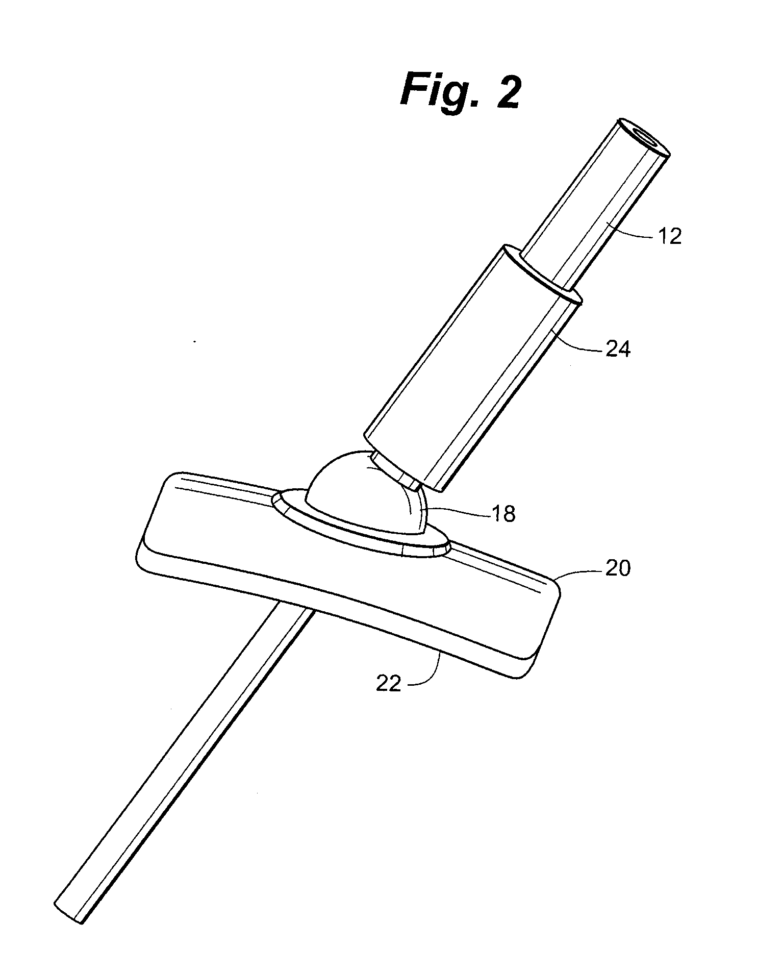 Anchorless Non-Invasive Force Dissipation System for Orthopedic Instrumentation