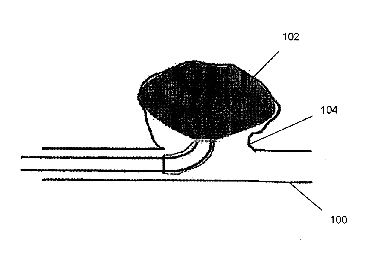 Aneurysm treatment apparatus