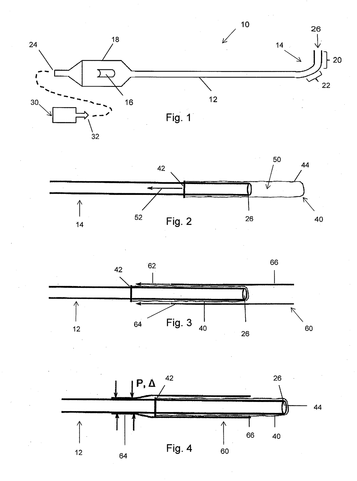 Aneurysm treatment apparatus