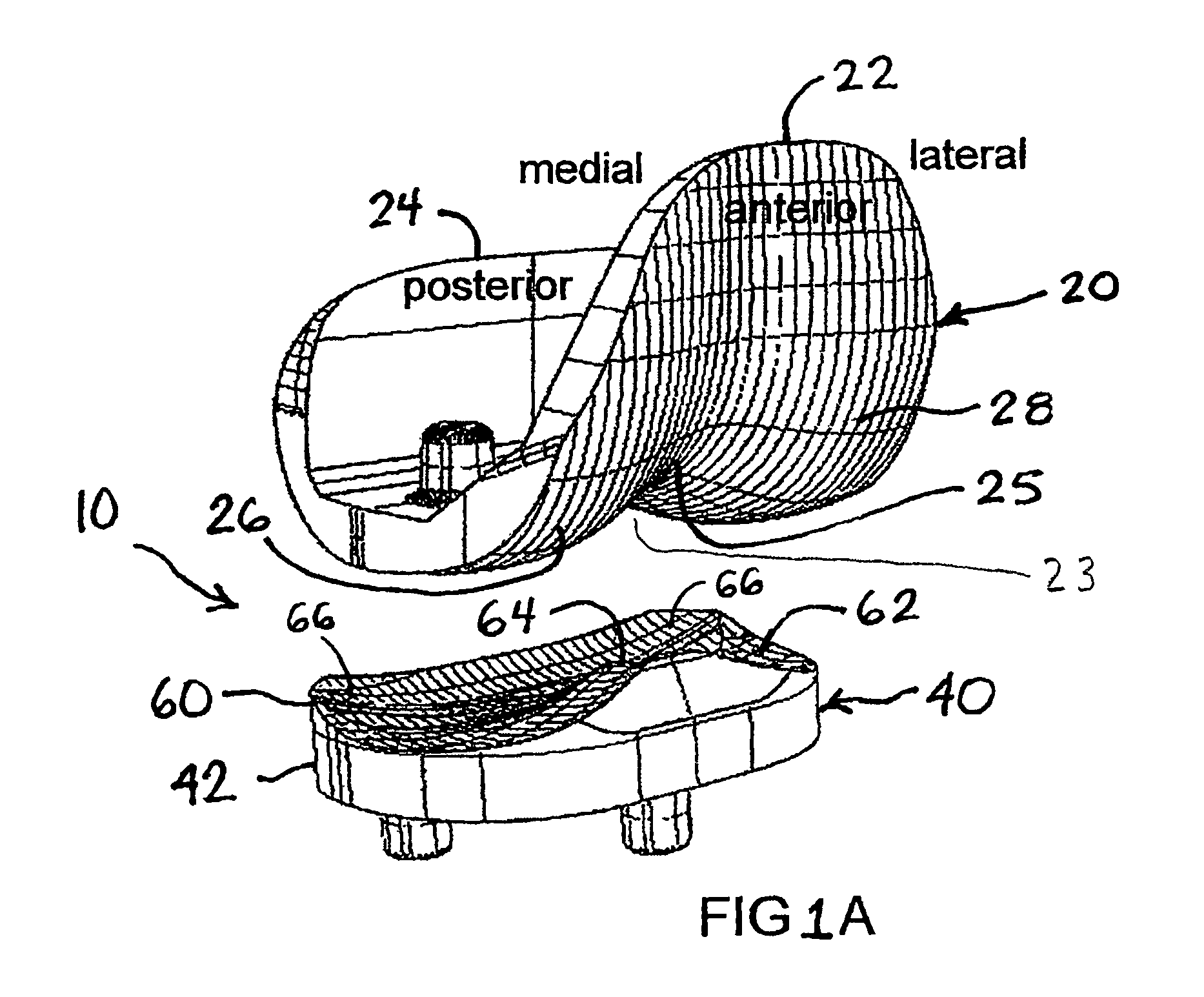 Surface guided knee replacement