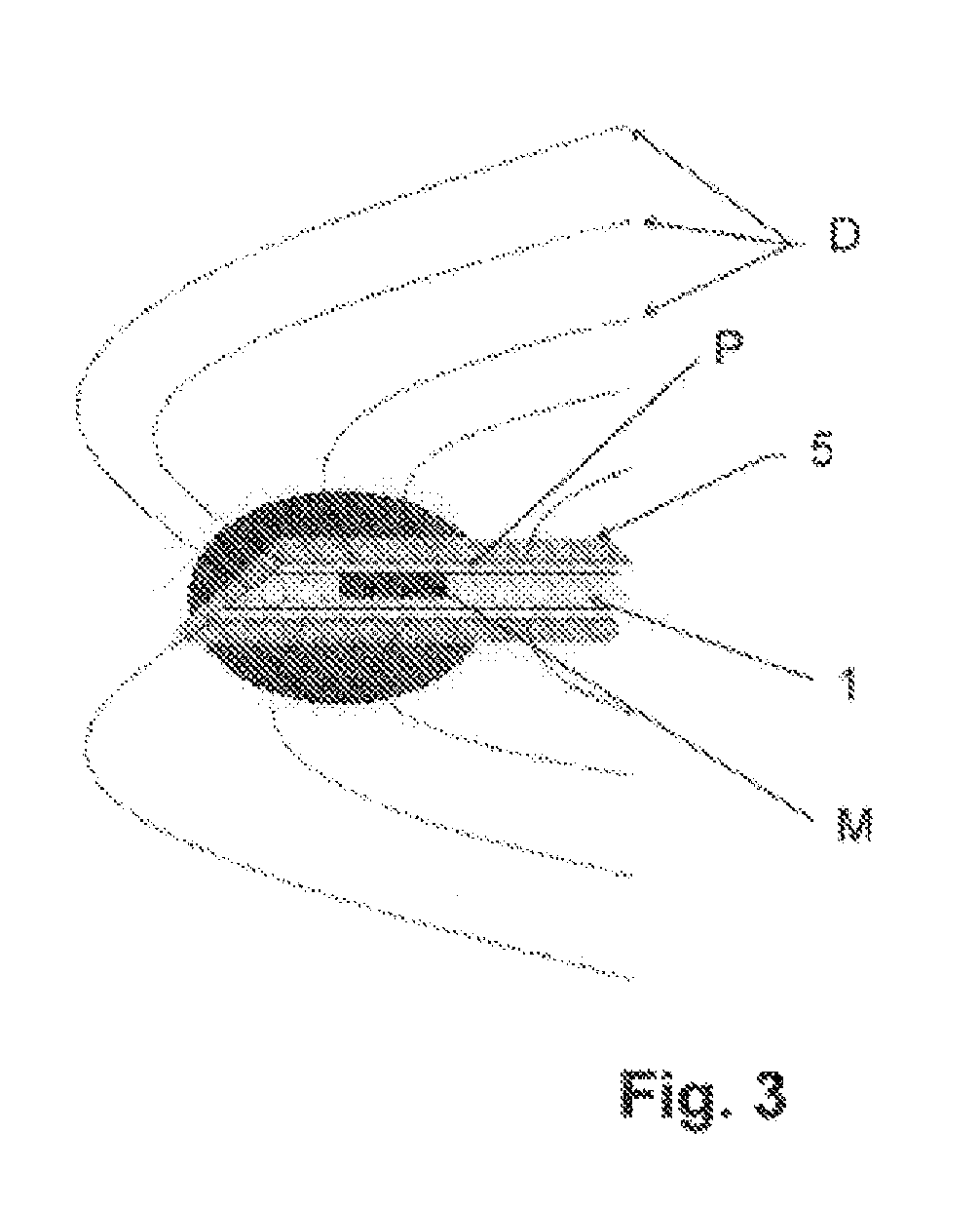 System for preventing bacterial infections in needle trajectories