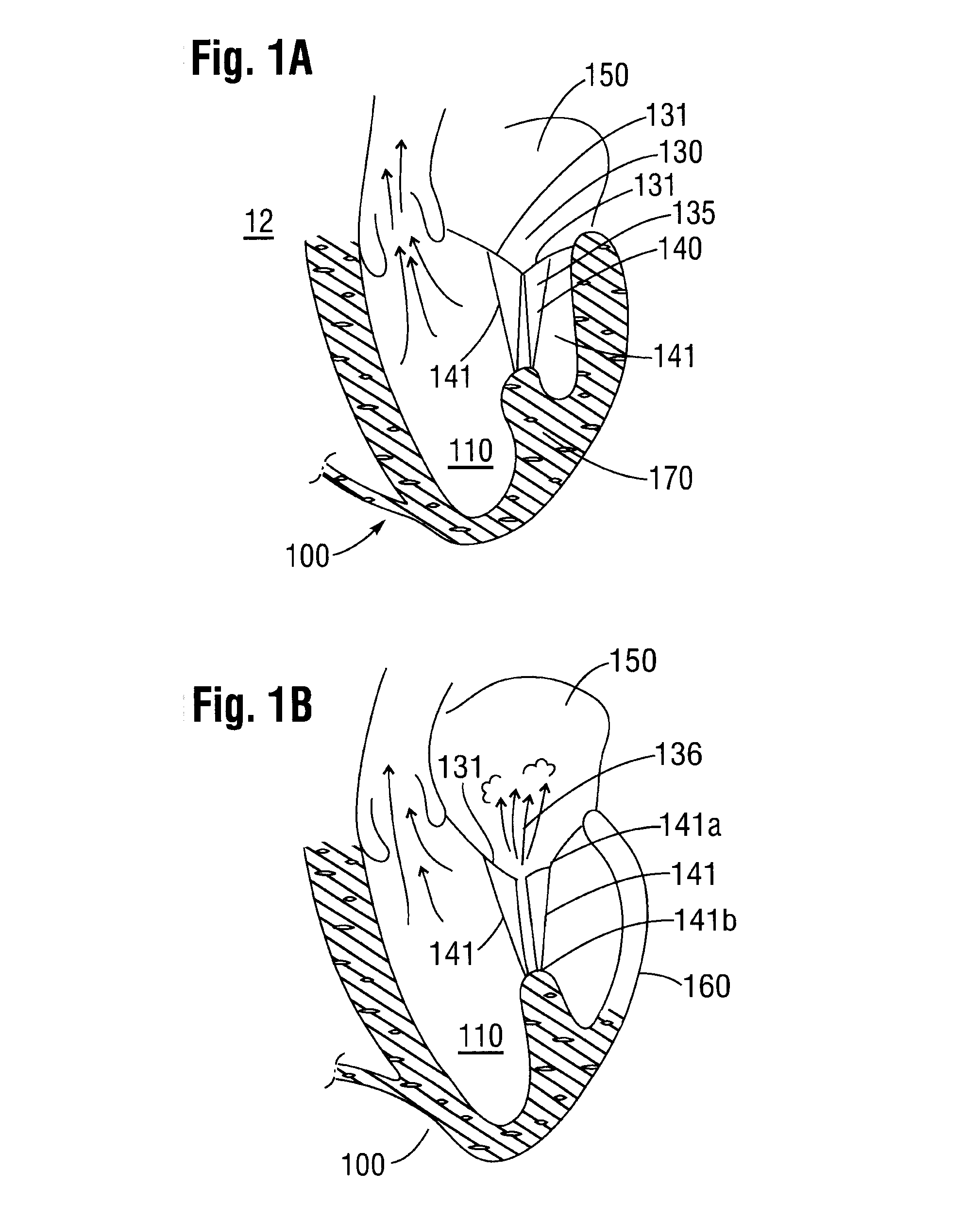 System and a method for altering the geometry of the heart