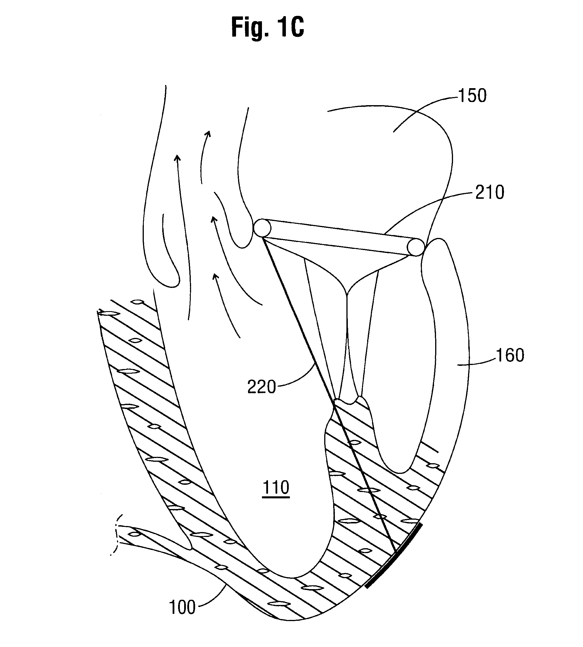 System and a method for altering the geometry of the heart