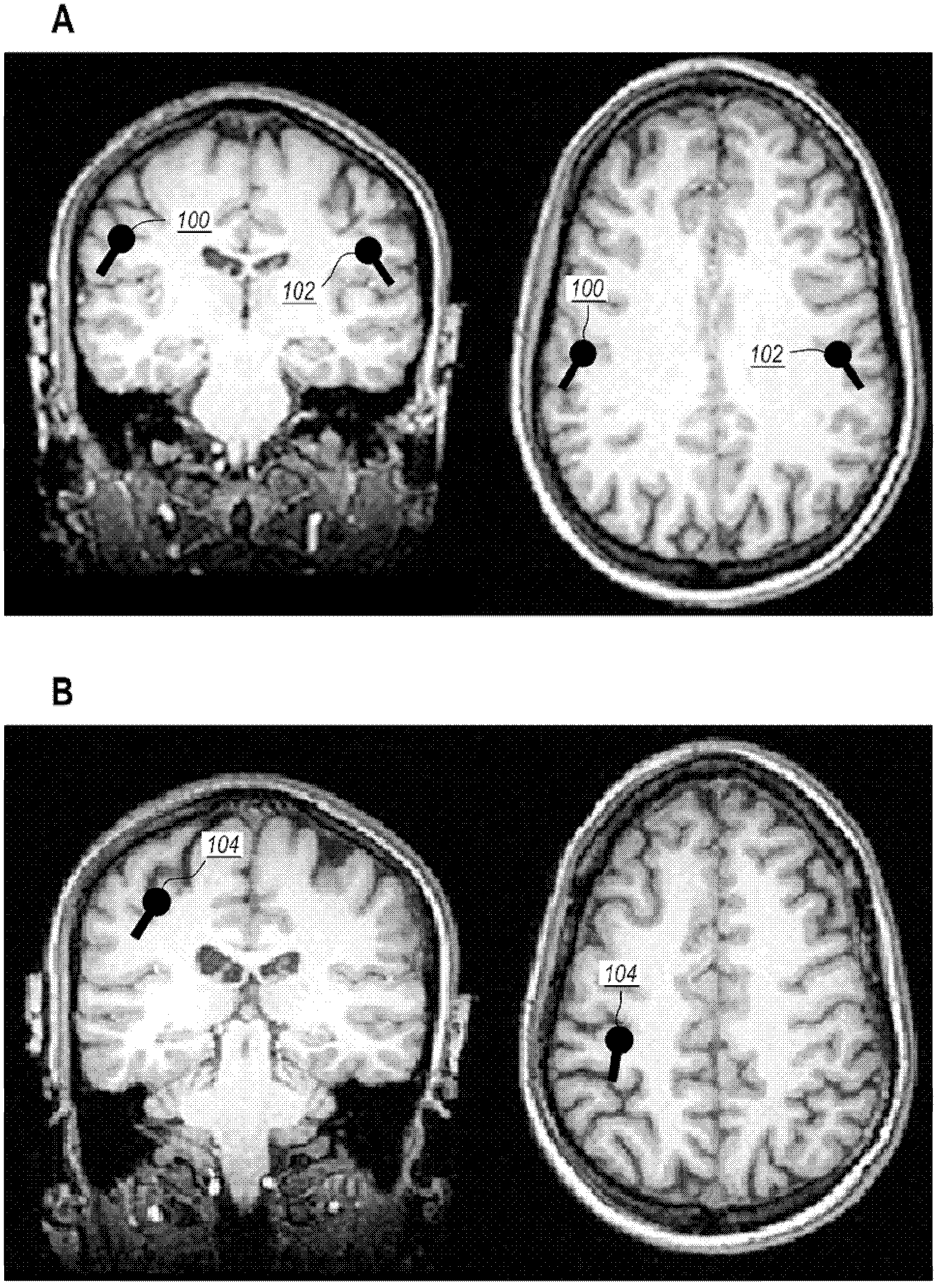 Device, system, and method for mechanosensory nerve ending stimulation